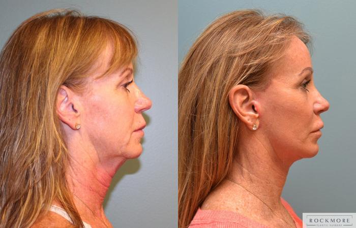 Before & After Neck Lift Case 158 View #5 View in Albany & Latham, New York