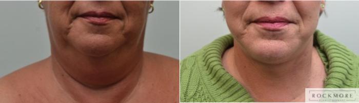 Before & After Neck Lift Case 229 View #1 View in Albany & Latham, New York