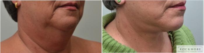 Before & After Neck Lift Case 229 View #2 View in Albany & Latham, New York