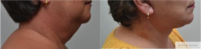 Before & After Neck Lift Case 229 View #3 View in Albany & Latham, New York