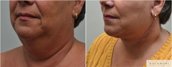 Before & After Neck Lift Case 229 View #4 View in Albany & Latham, New York