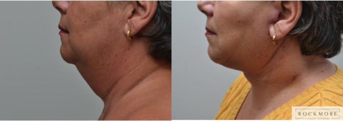 Before & After Neck Lift Case 229 View #5 View in Albany & Latham, New York