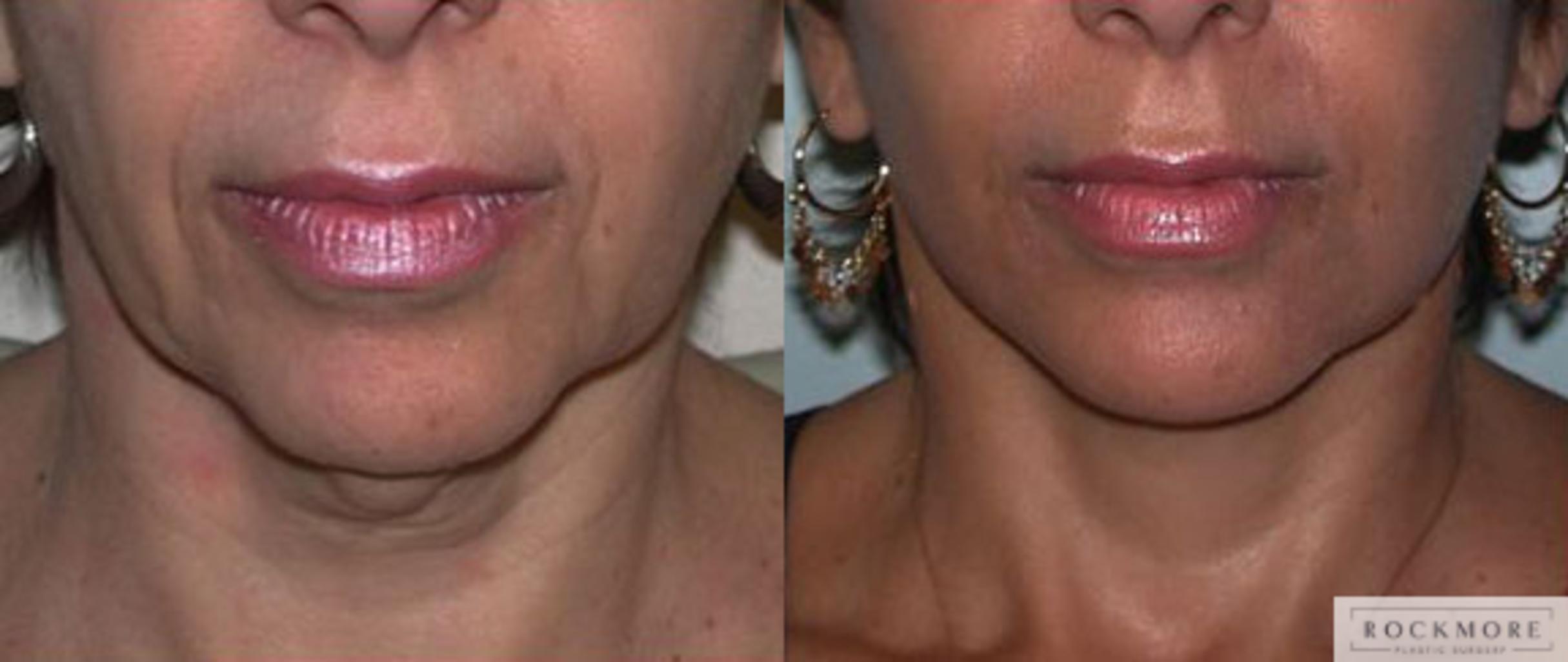 Before & After Neck Lift Case 72 View #1 View in Albany & Latham, New York