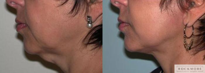 Before & After Neck Lift Case 72 View #2 View in Albany & Latham, New York