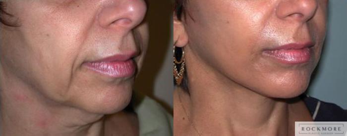 Before & After Neck Lift Case 72 View #3 View in Albany & Latham, New York