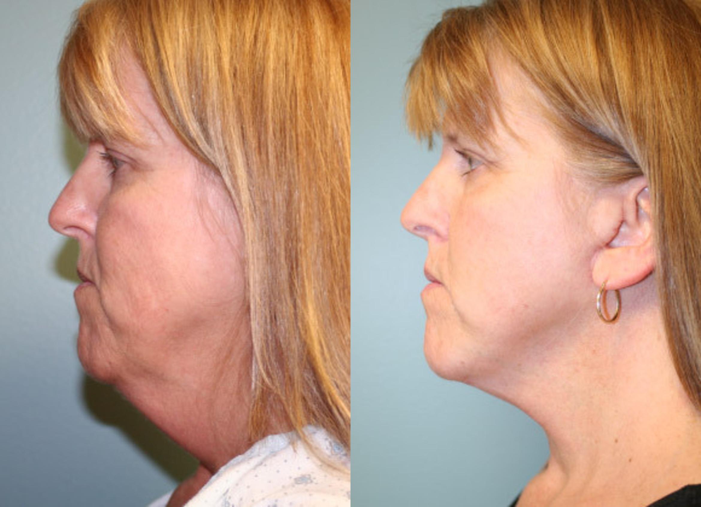Before & After Neck Lift Case 156 View #1 View in Albany & Latham, New York