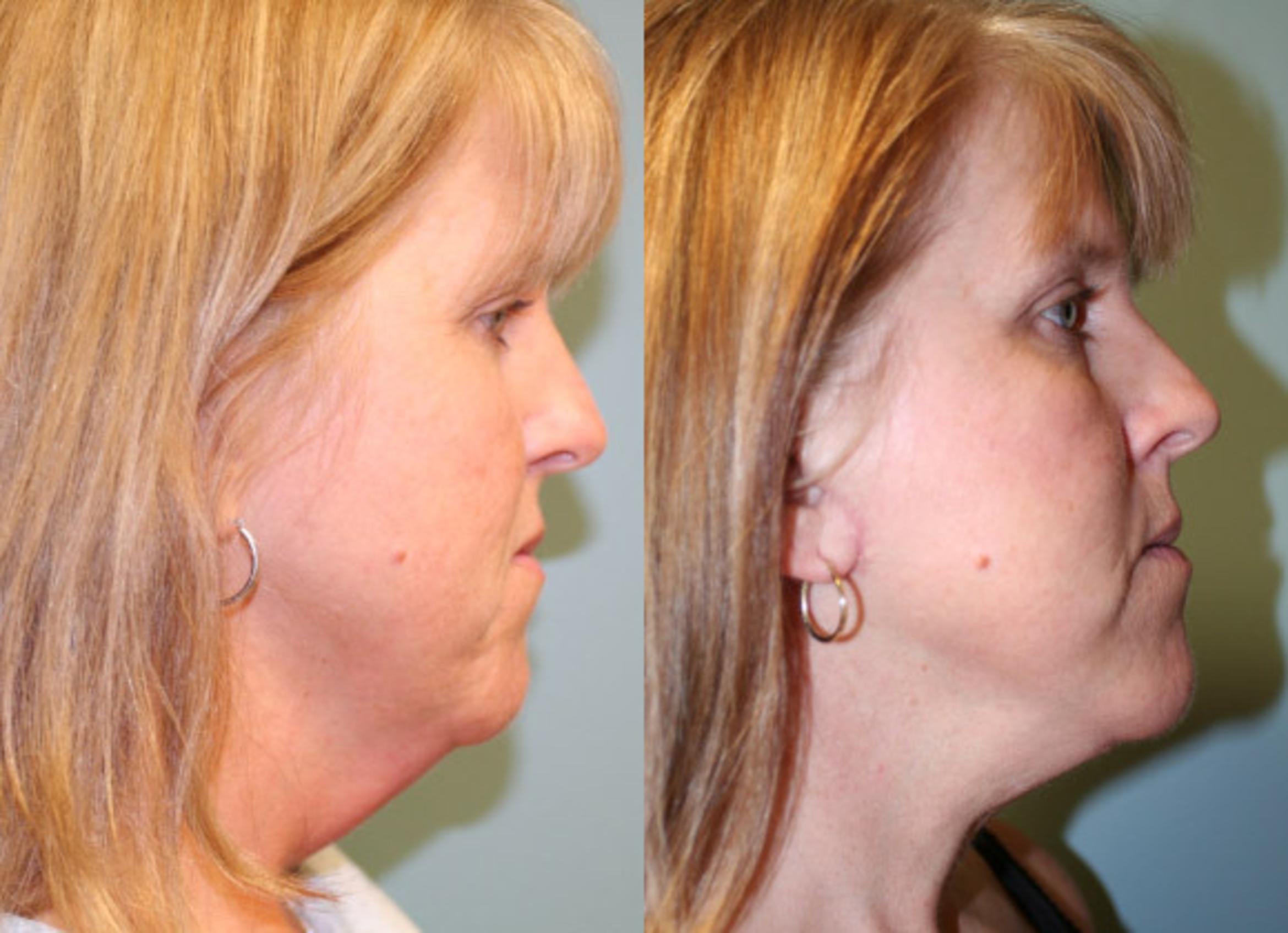 Before & After Neck Lift Case 156 View #2 View in Albany & Latham, New York