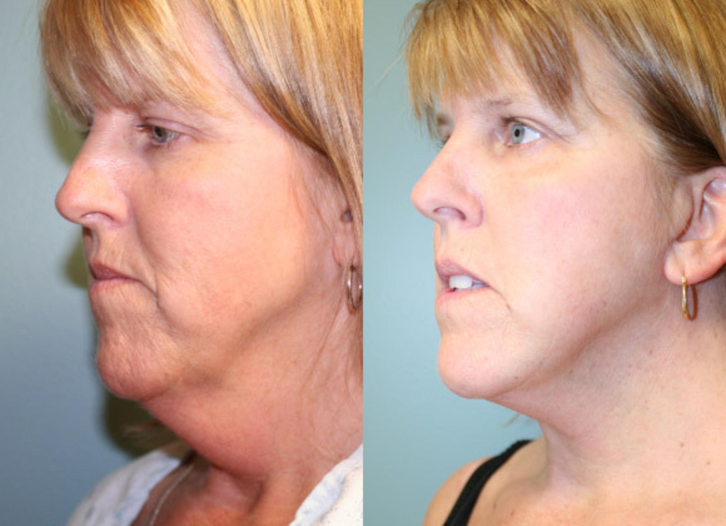 Neck Lift Before & After Photos Patient 156 Albany