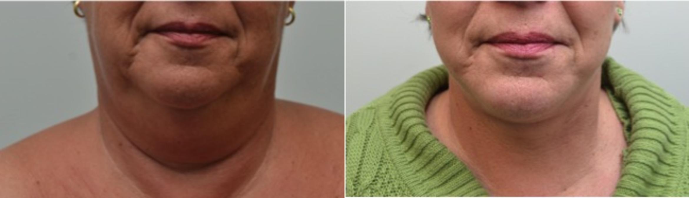 Before & After Neck Lift Case 229 View #1 View in Albany & Latham, New York