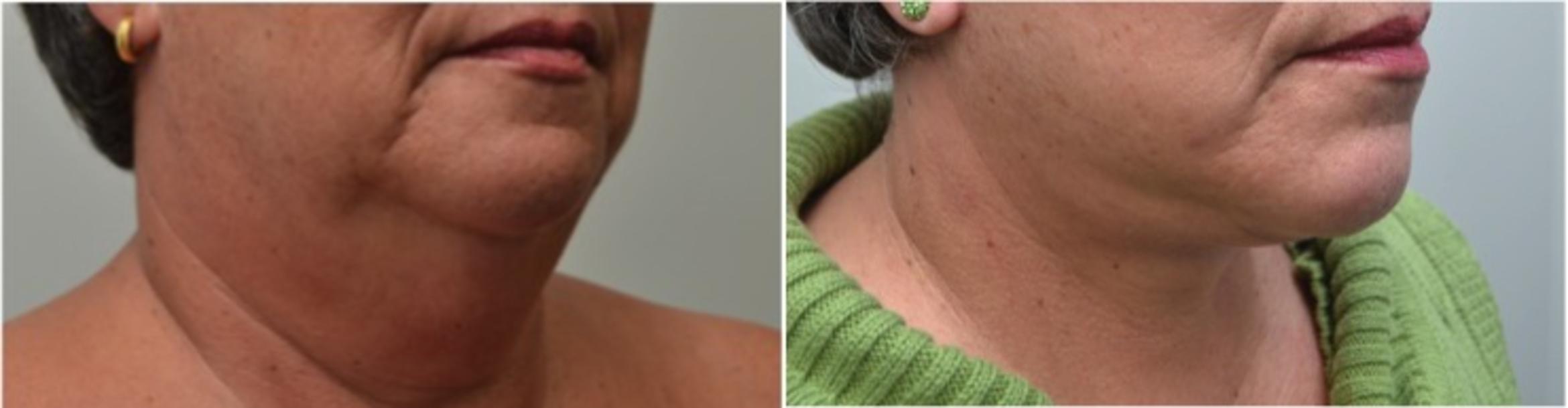 Before & After Neck Lift Case 229 View #2 View in Albany & Latham, New York