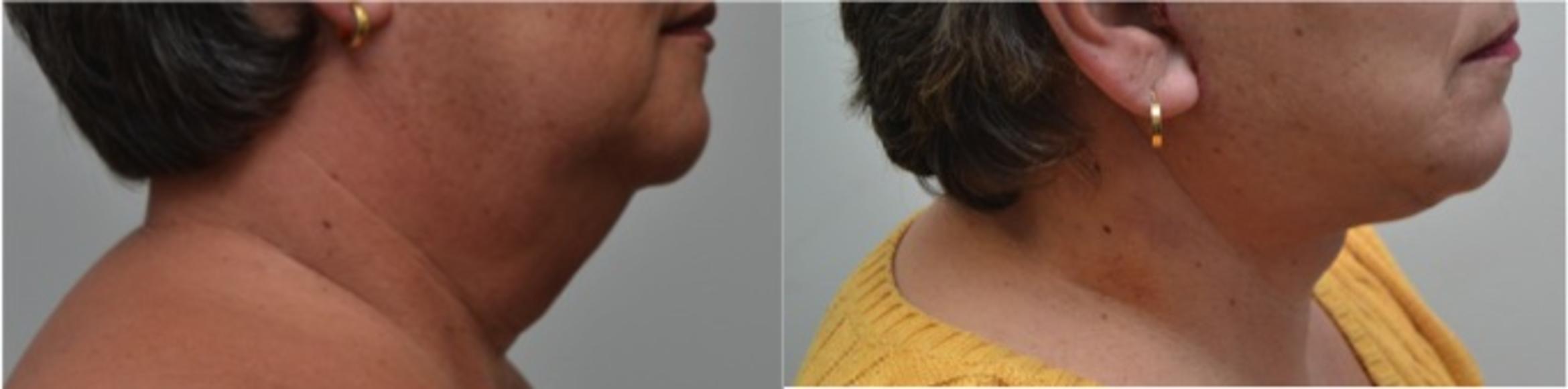 Before & After Neck Lift Case 229 View #3 View in Albany & Latham, New York