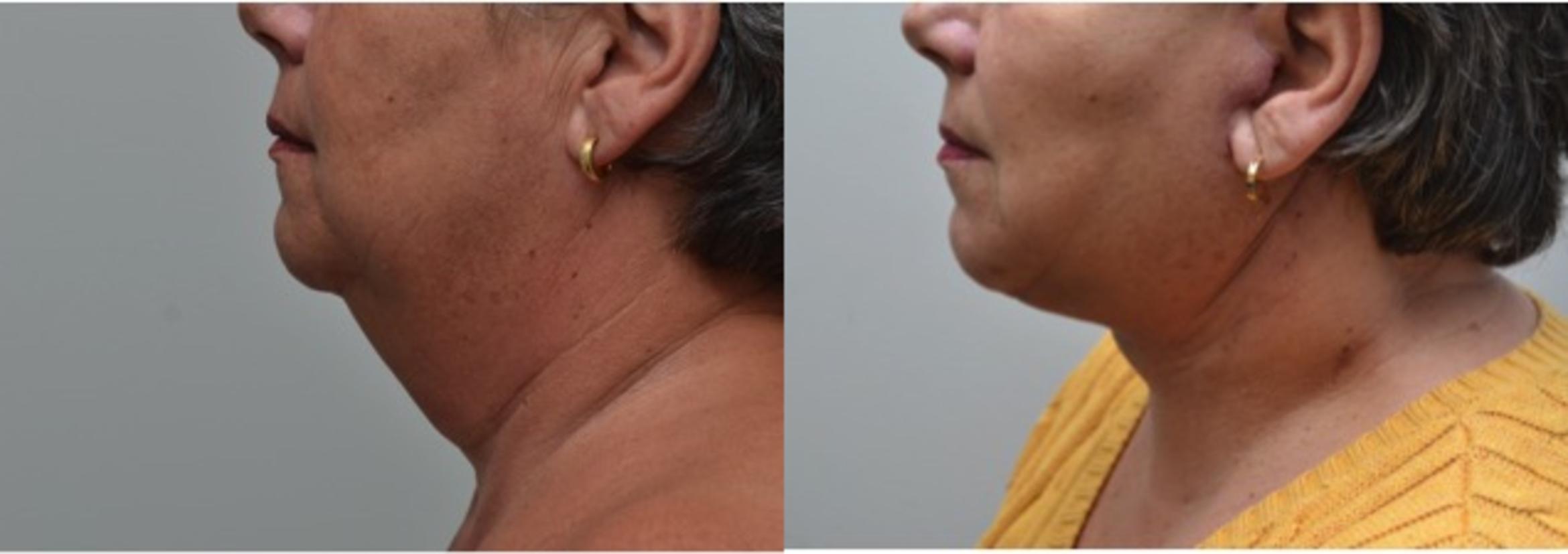 Before & After Neck Lift Case 229 View #5 View in Albany & Latham, New York