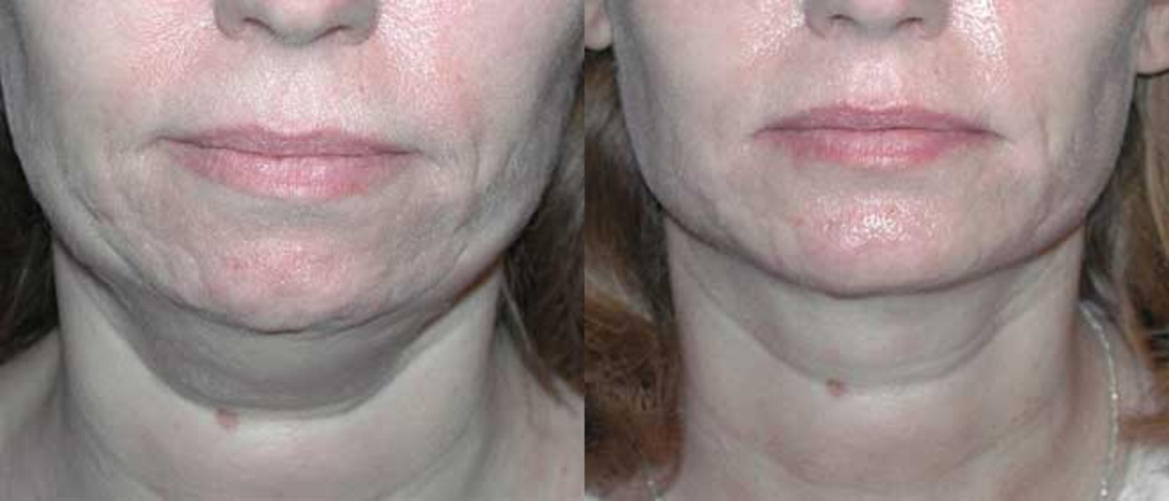 Before & After Neck Lift Case 58 View #1 View in Albany & Latham, New York