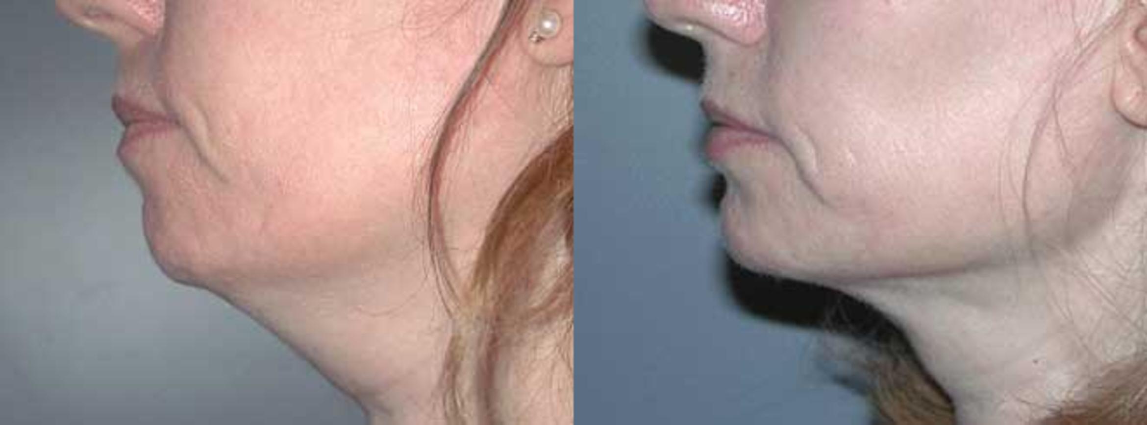 Before & After Neck Lift Case 58 View #2 View in Albany & Latham, New York