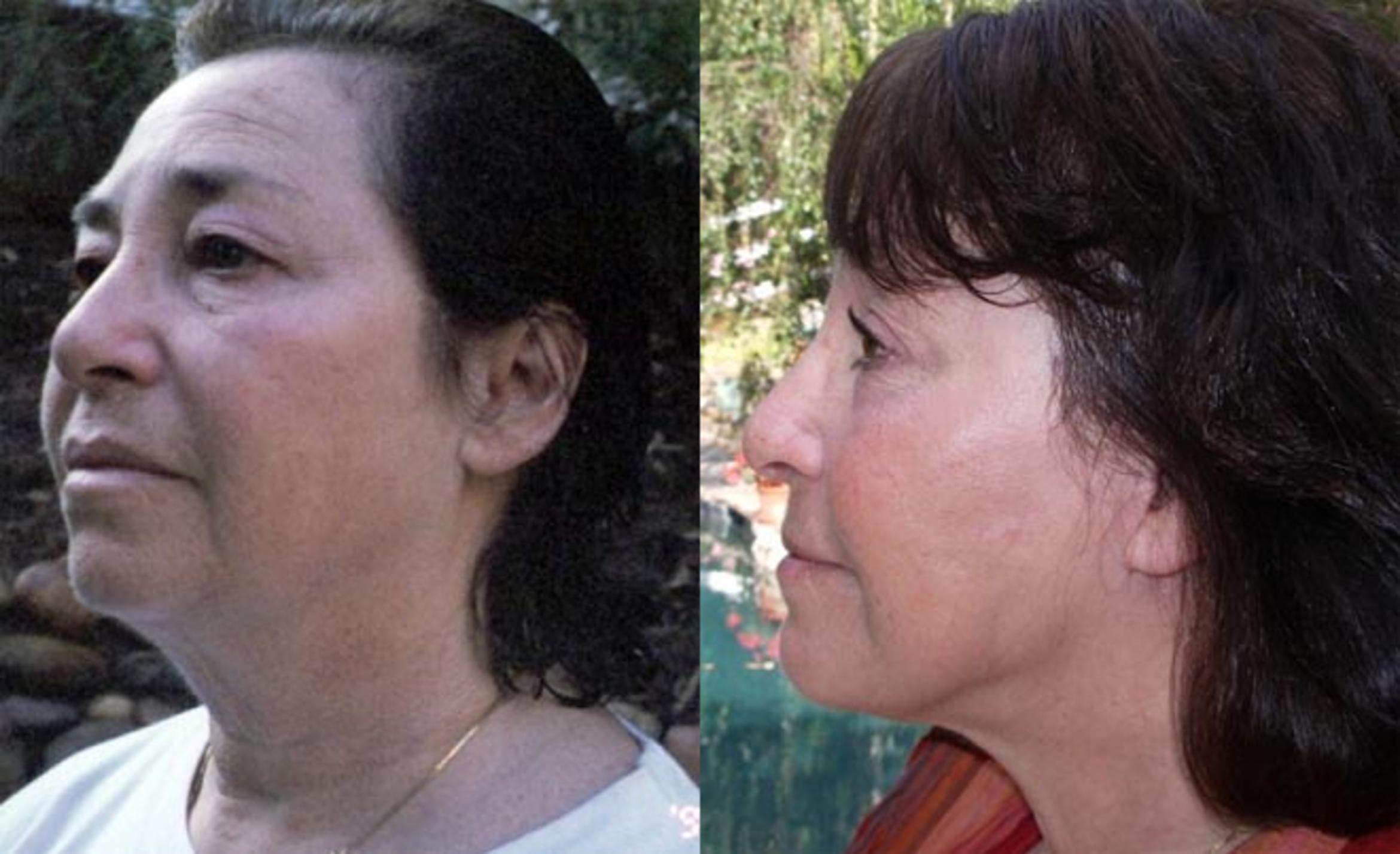 Before & After Neck Lift Case 59 View #2 View in Albany & Latham, New York