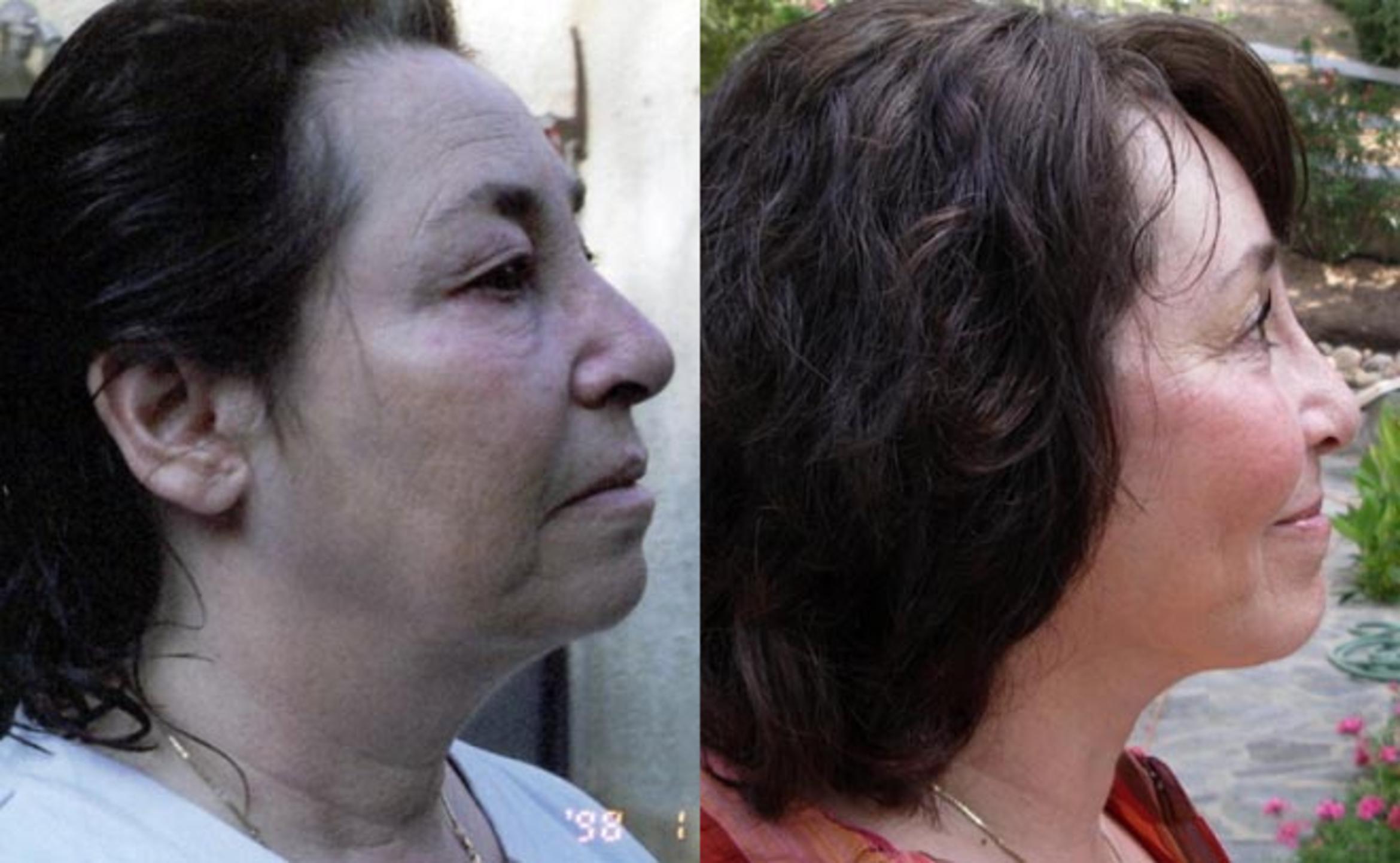 Before & After Neck Lift Case 59 View #3 View in Albany & Latham, New York