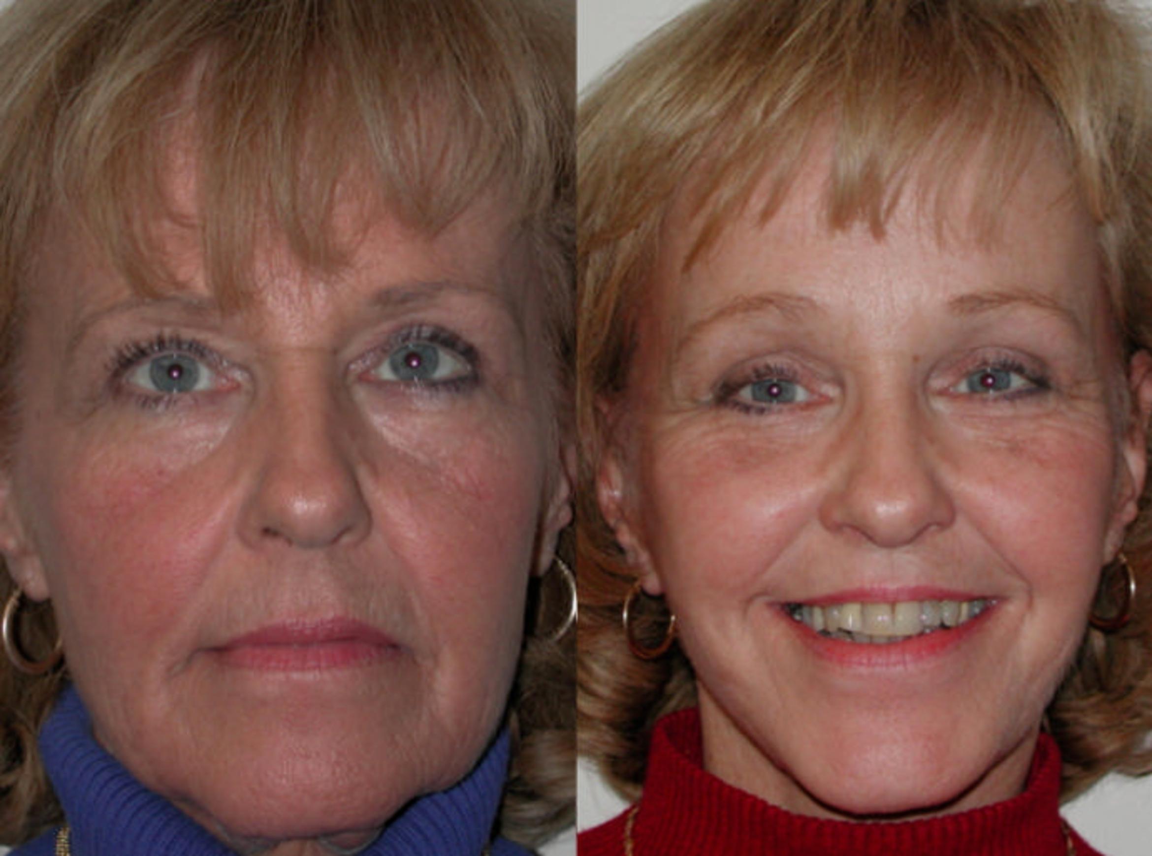 Before & After Neck Lift Case 60 View #1 View in Albany & Latham, New York