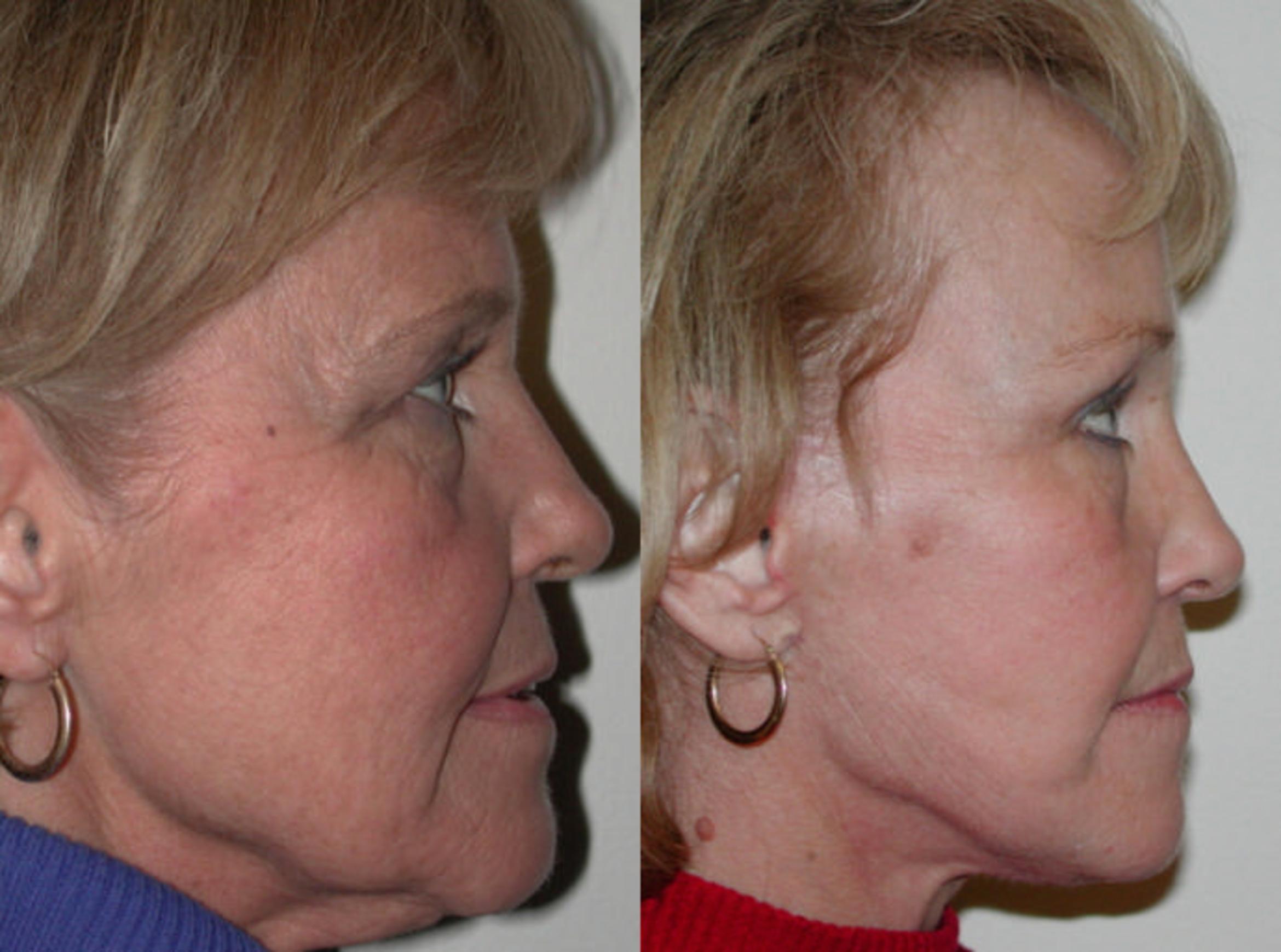 Before & After Neck Lift Case 60 View #2 View in Albany & Latham, New York