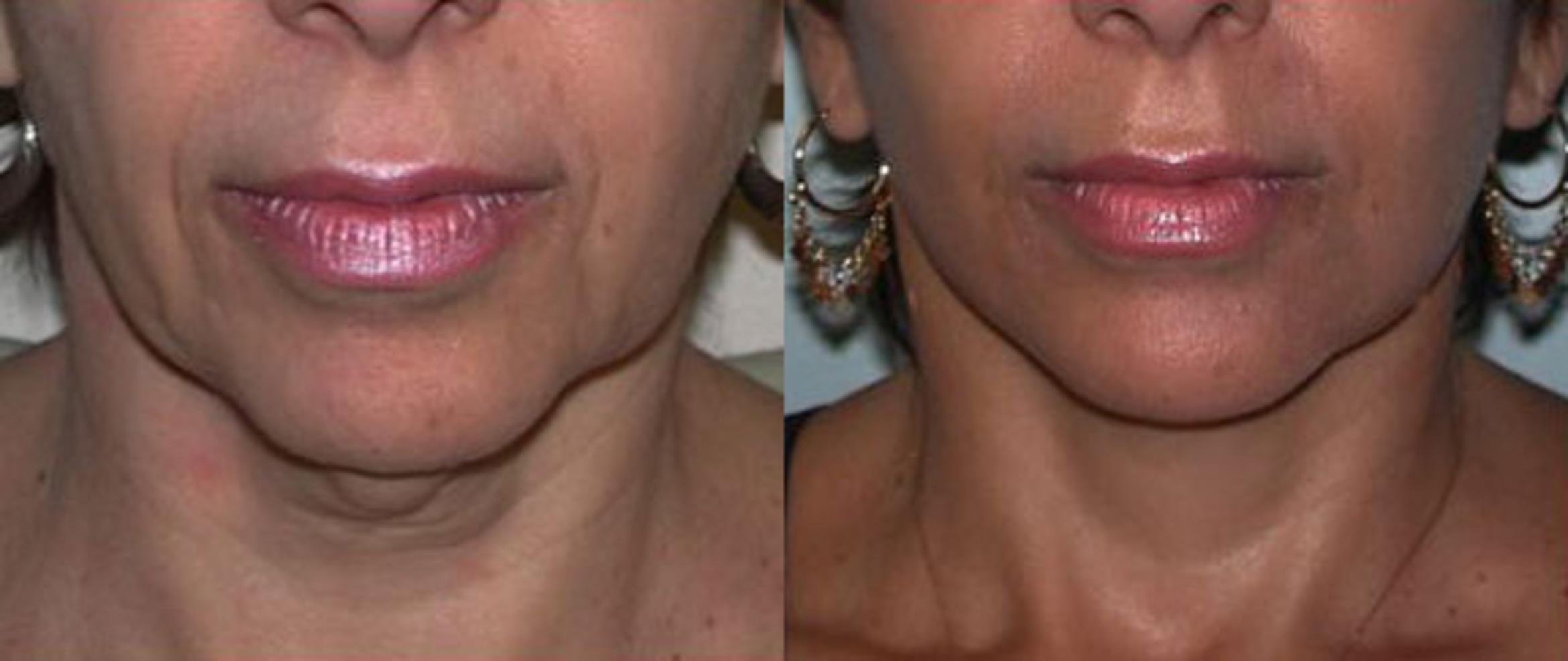 Before & After Neck Lift Case 72 View #1 View in Albany & Latham, New York