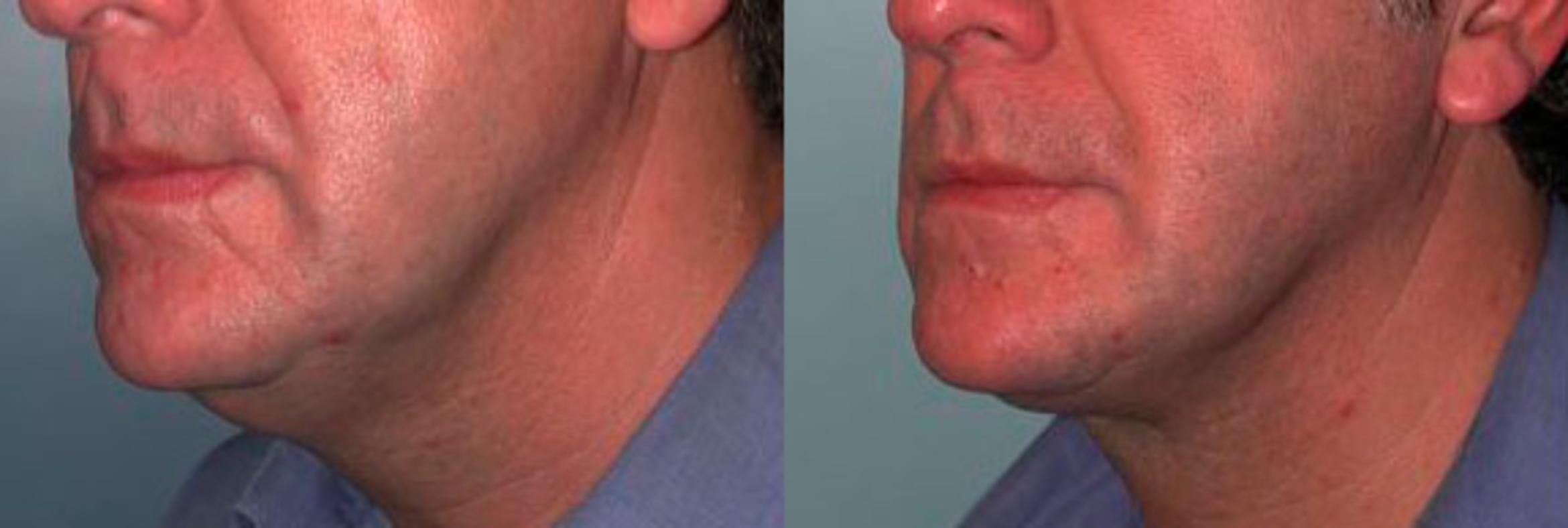 Before & After Neck Lift Case 73 View #2 View in Albany & Latham, New York