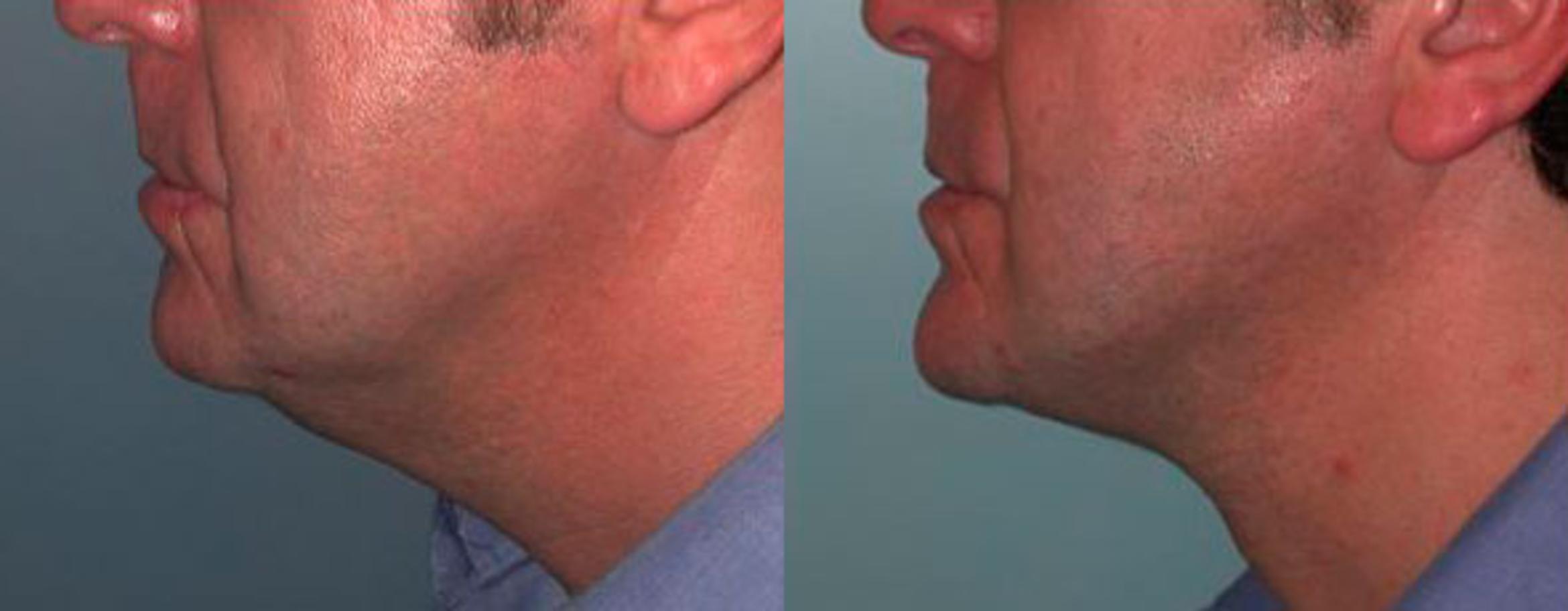 Before & After Neck Lift Case 73 View #3 View in Albany & Latham, New York
