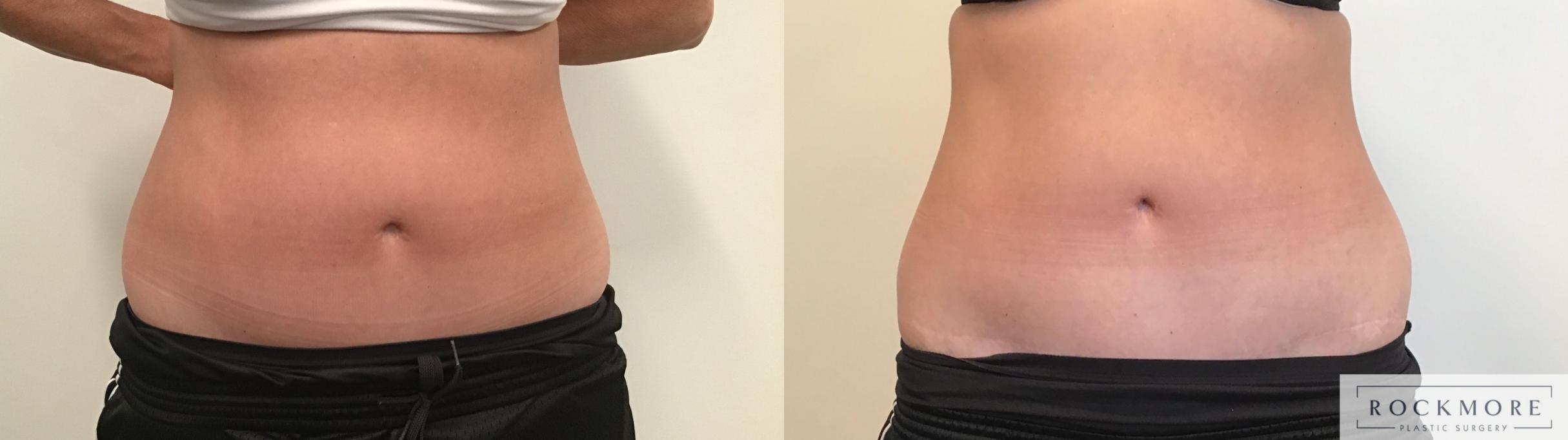 Before & After Non-Invasive Fat Removal Case 338 Front View in Albany & Latham, New York