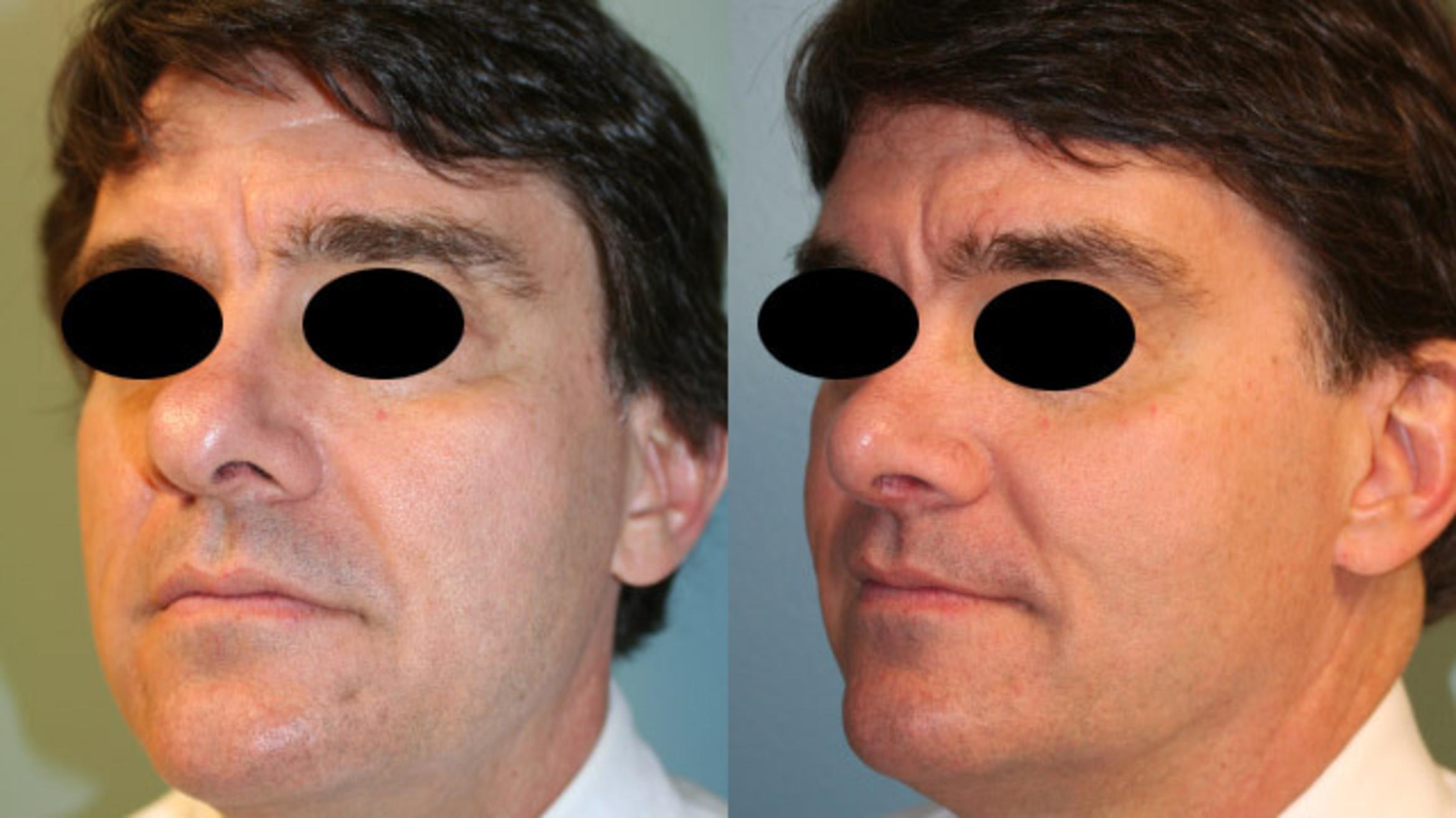 Before & After Rhinoplasty Case 152 View #1 View in Albany & Latham, New York
