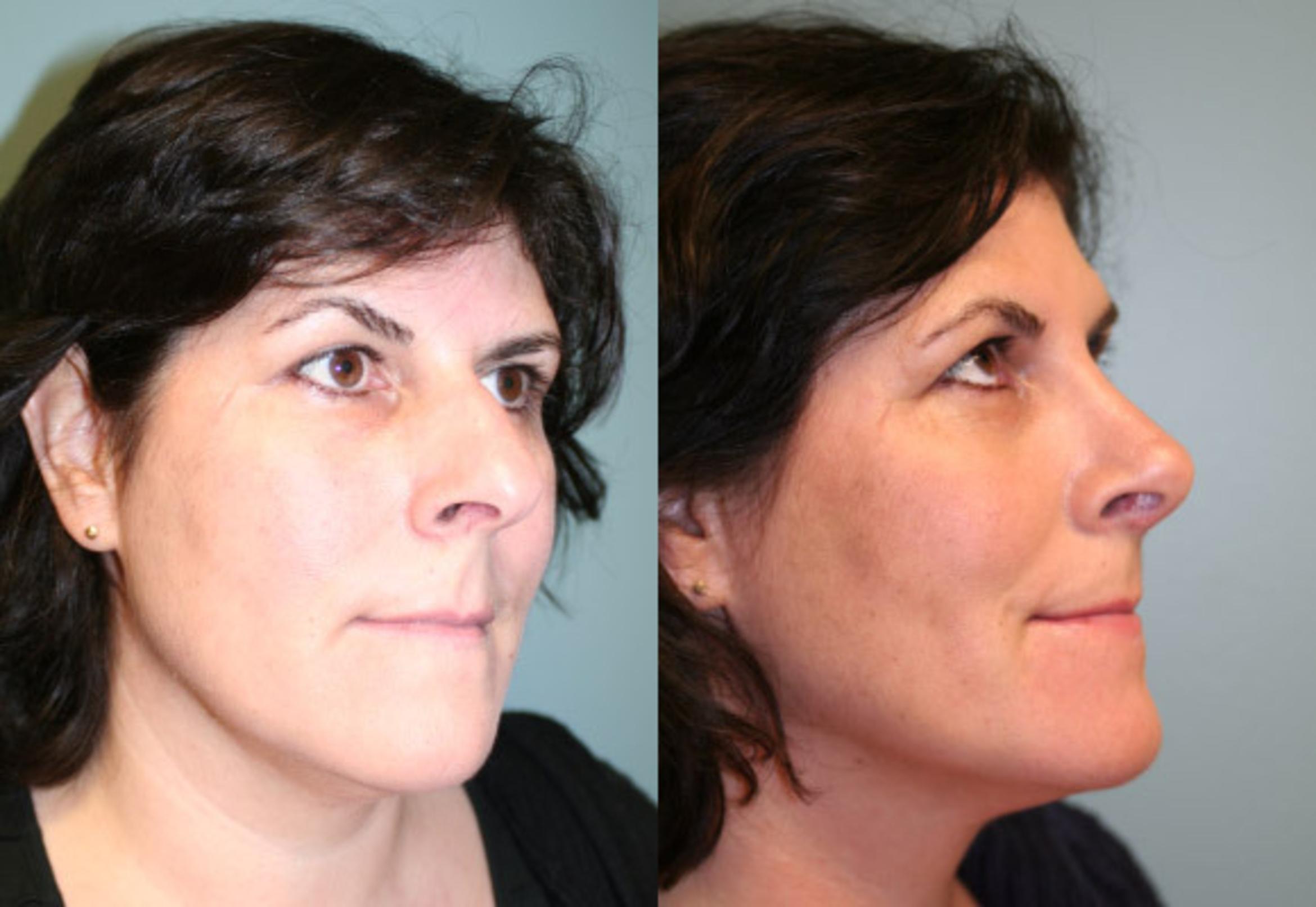 Rhinoplasty Before & After Photos Patient 155 Albany & Latham, New York Rockmore Plastic Surgery