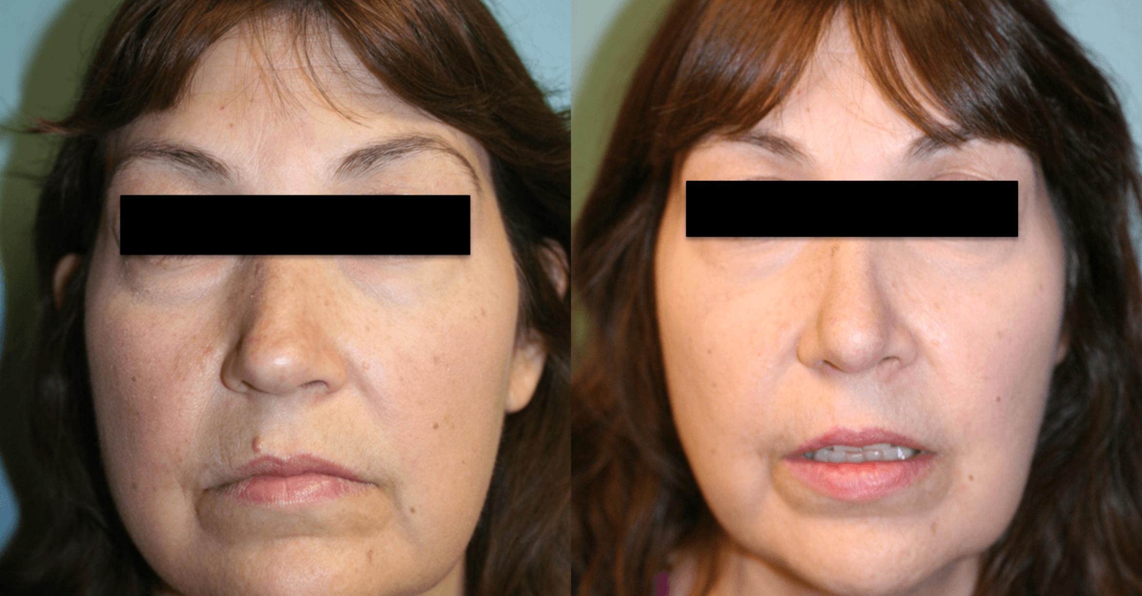 Rhinoplasty Before & After Photos Patient 169 Albany & Latham, New York Rockmore Plastic Surgery