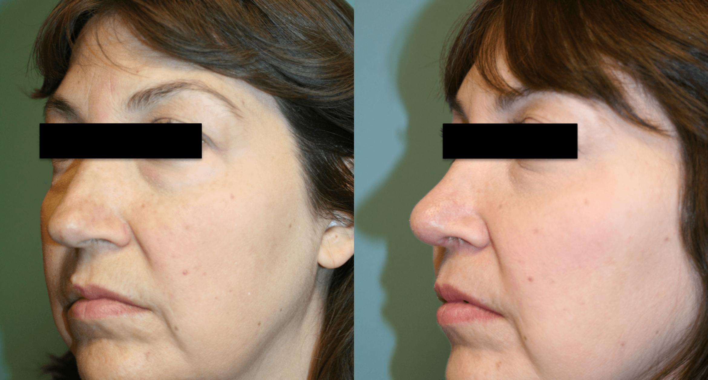 Before & After Rhinoplasty Case 169 View #2 View in Albany & Latham, New York