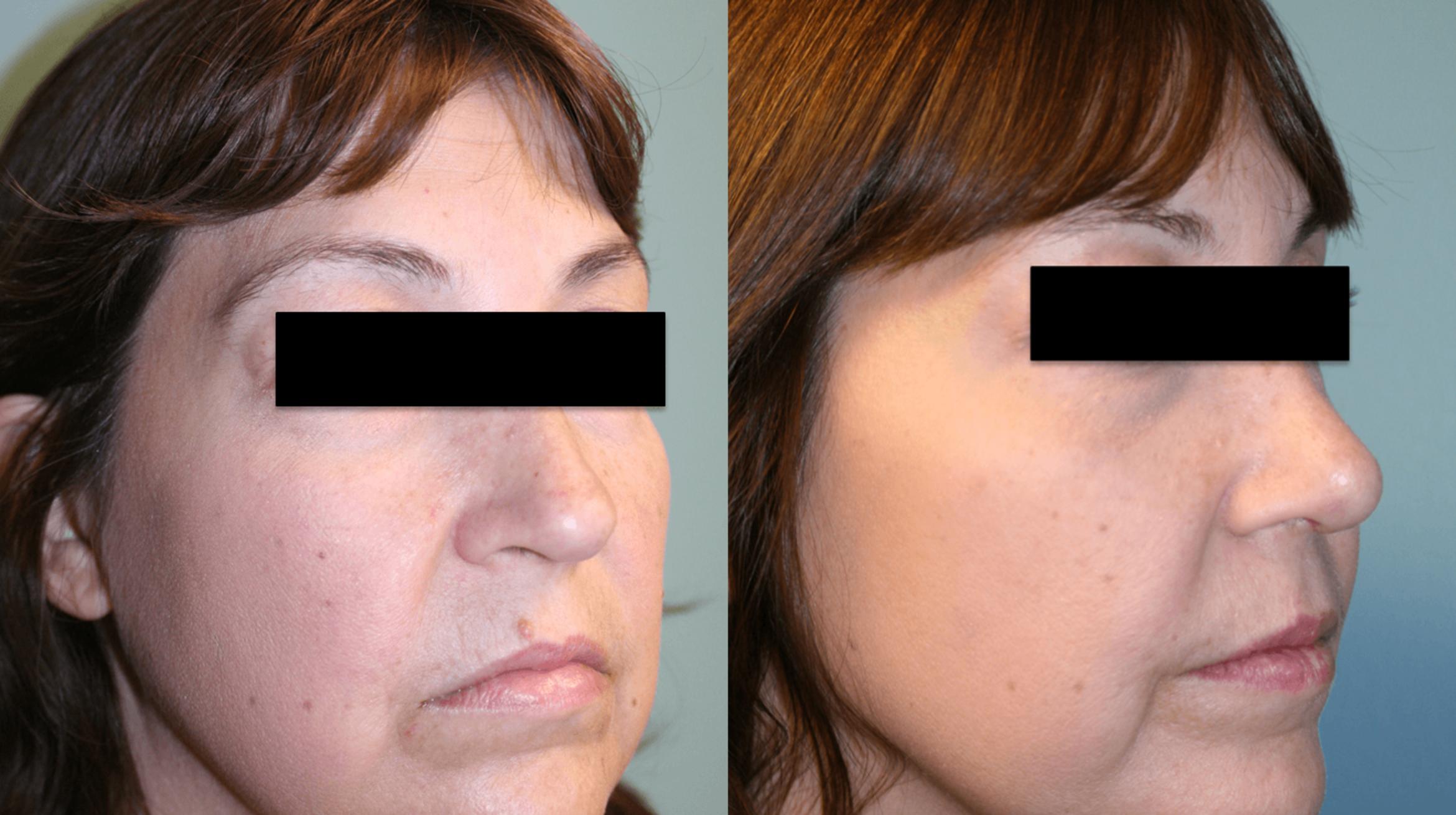 Before & After Rhinoplasty Case 169 View #3 View in Albany & Latham, New York