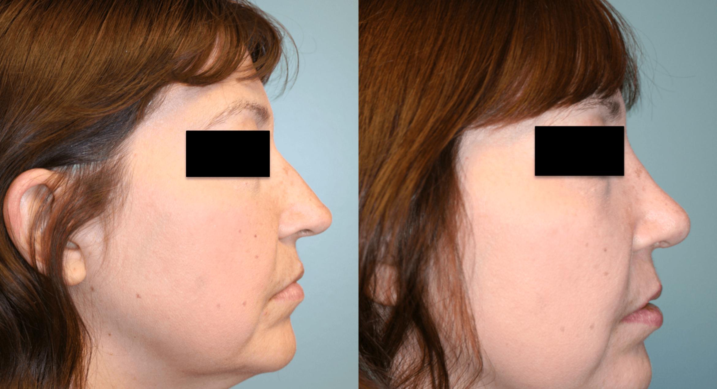 Before & After Rhinoplasty Case 169 View #4 View in Albany & Latham, New York