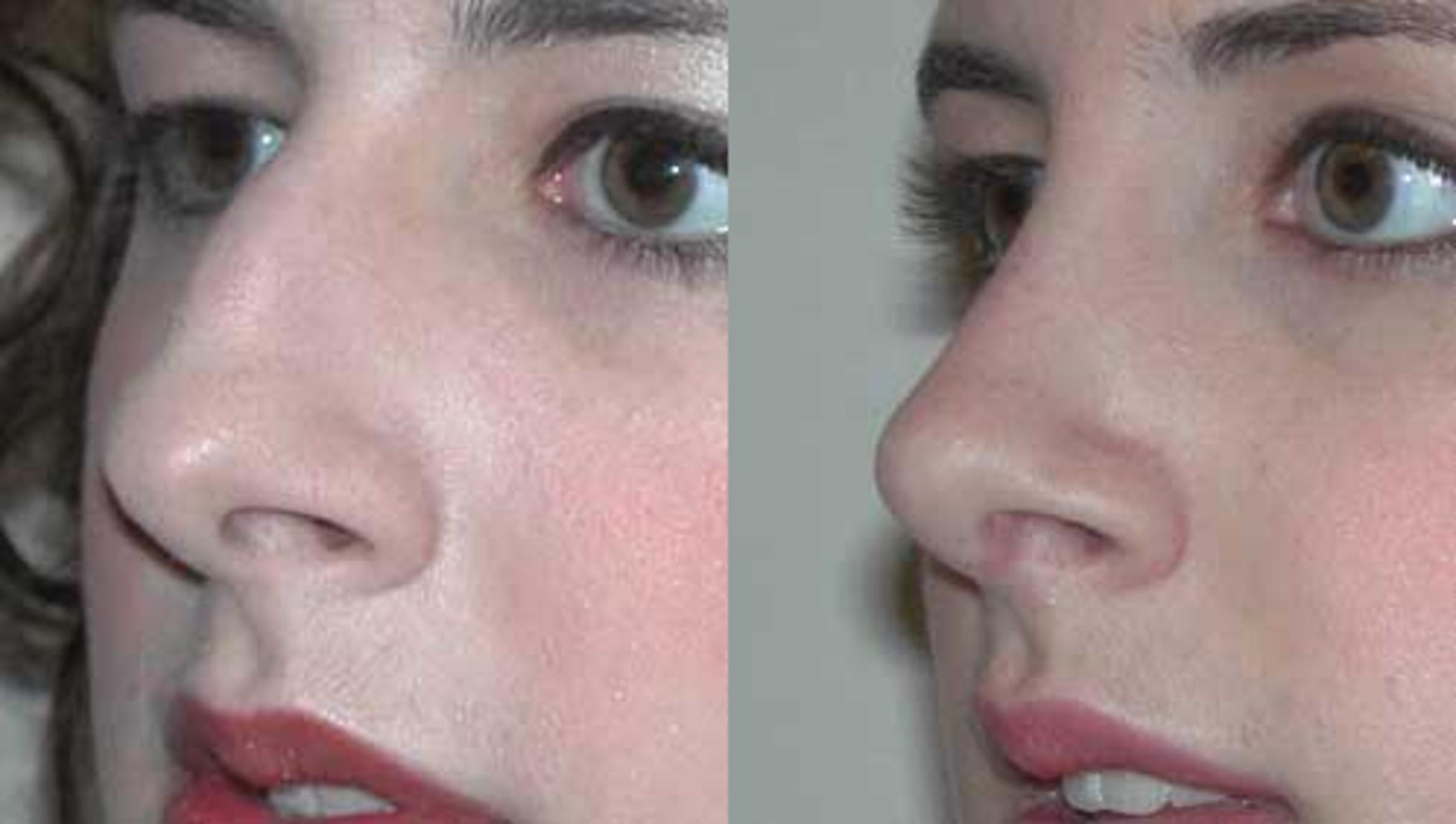 Before & After Rhinoplasty Case 2 View #1 View in Albany & Latham, New York
