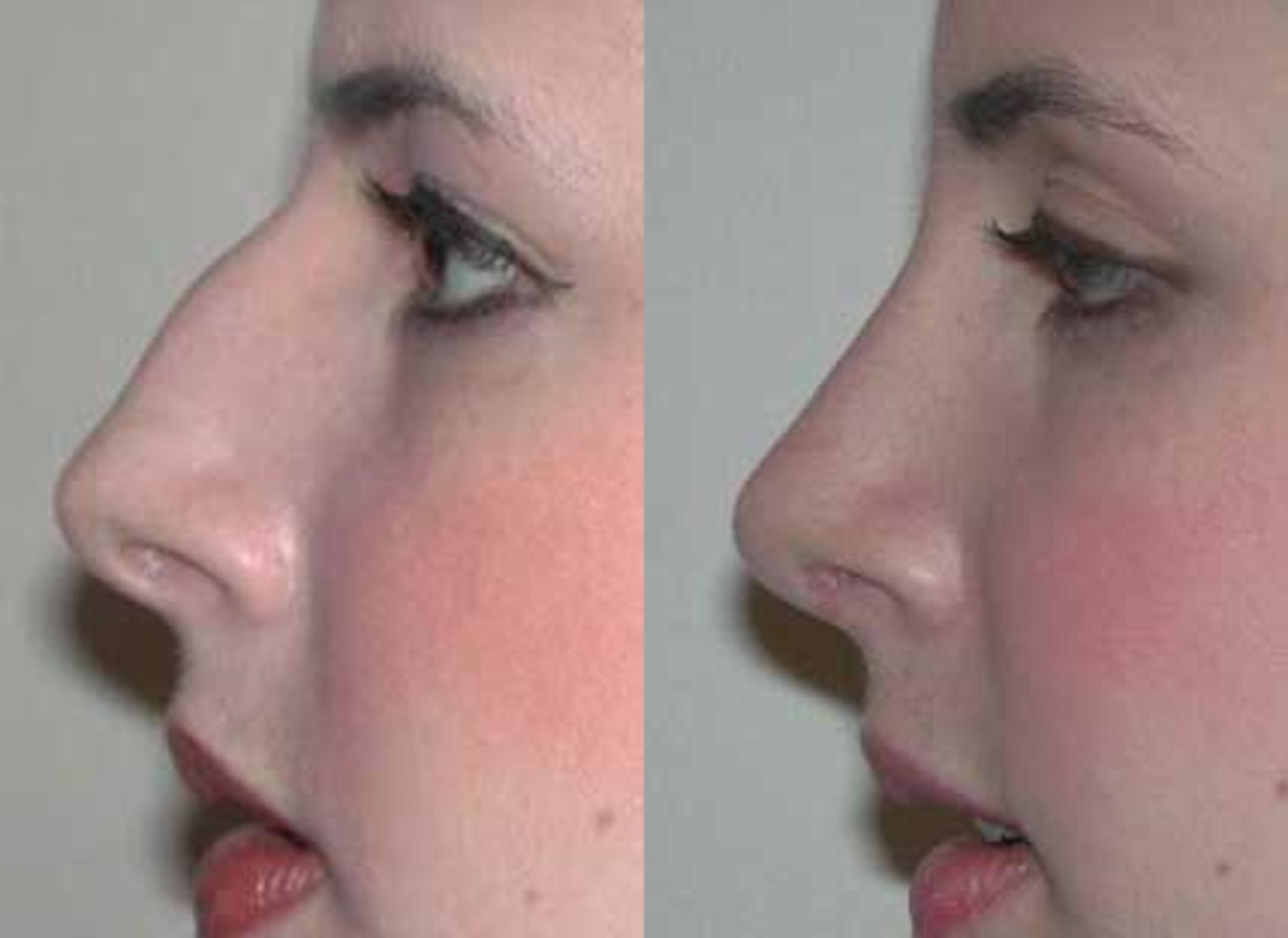 Before & After Rhinoplasty Case 2 View #2 View in Albany & Latham, New York