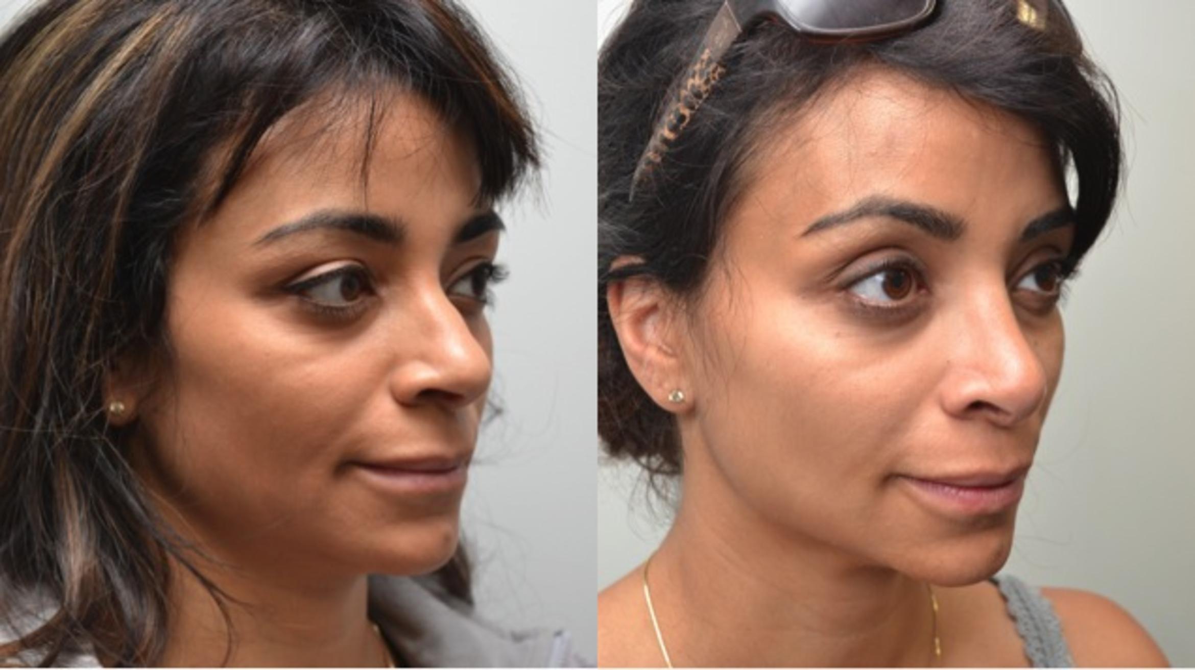 Before & After Rhinoplasty Case 208 View #1 View in Albany & Latham, New York