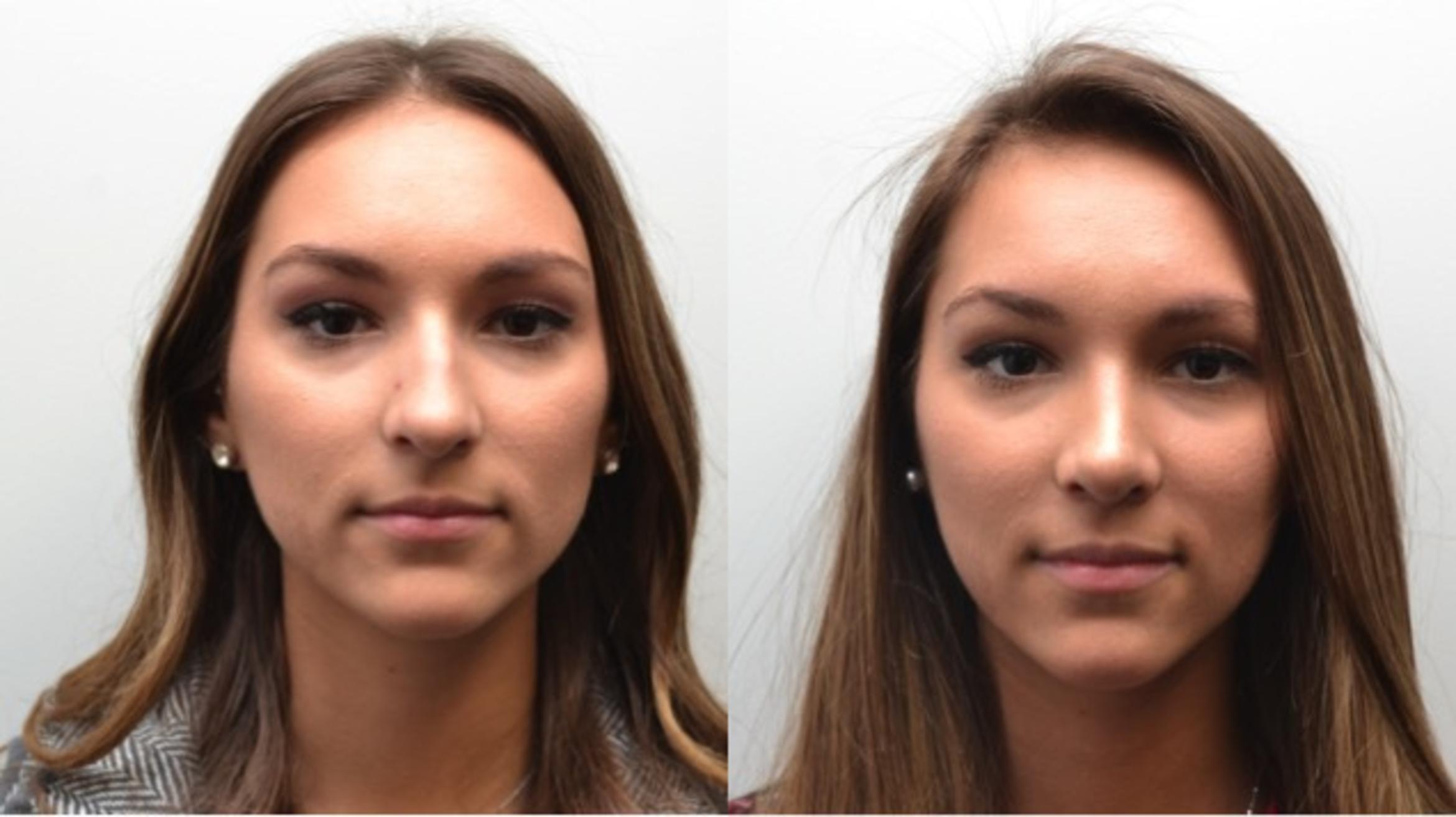 Rhinoplasty Before & After Photos Patient 239 Albany & Latham, New York Rockmore Plastic Surgery