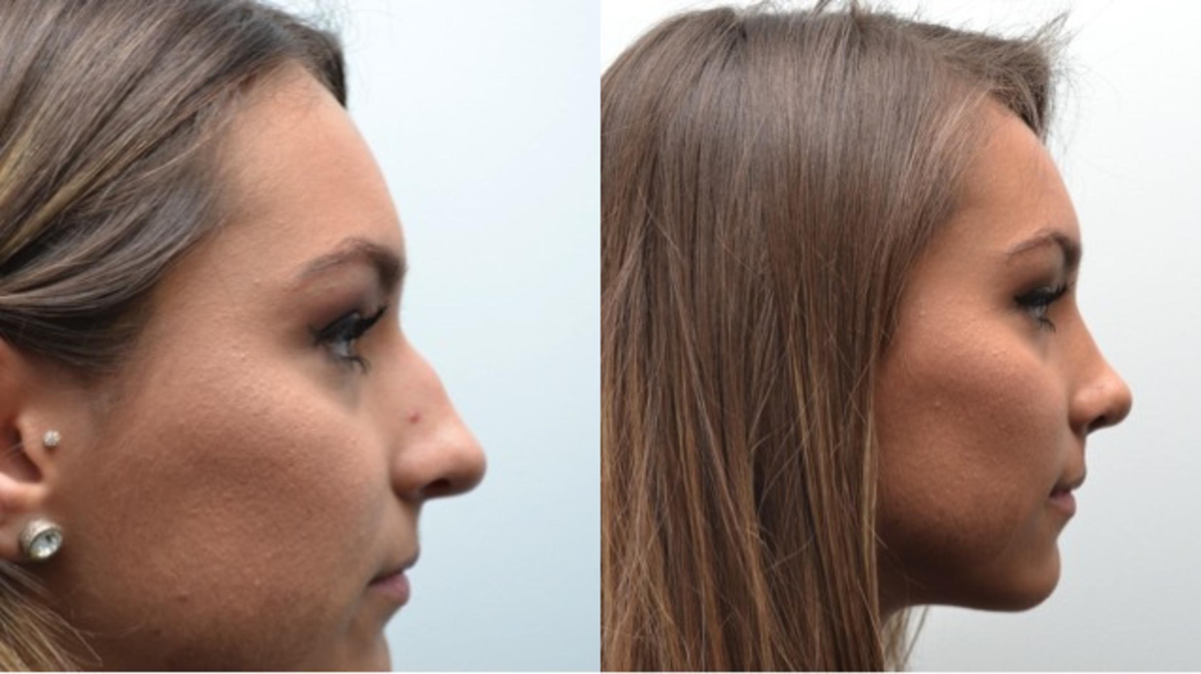 Before & After Rhinoplasty Case 239 View #3 View in Albany & Latham, New York