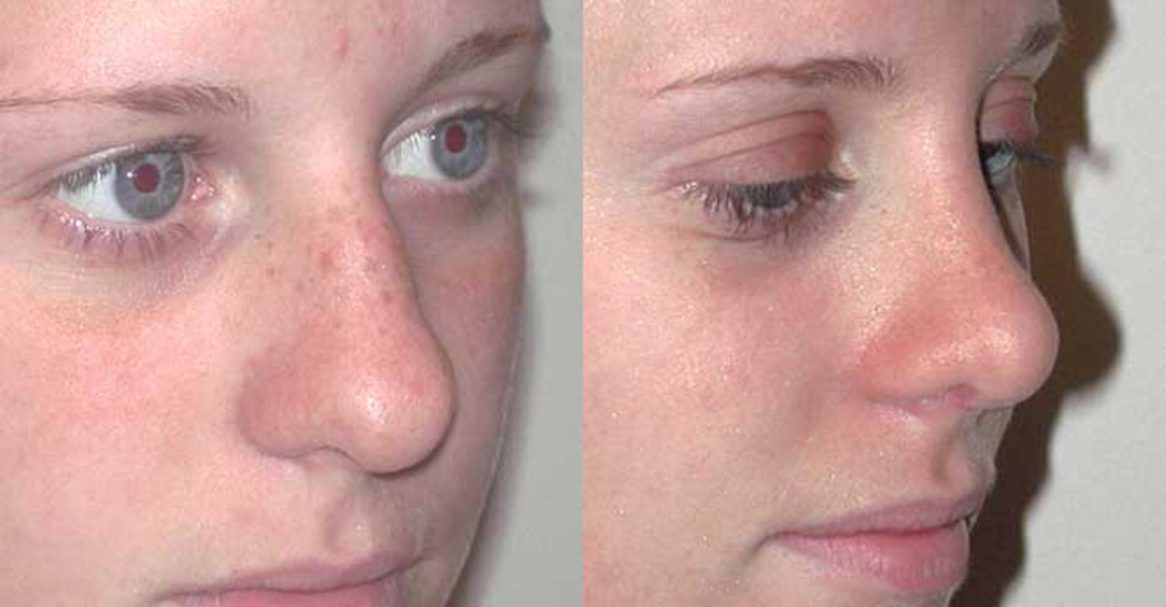 Before & After Rhinoplasty Case 25 View #2 View in Albany & Latham, New York