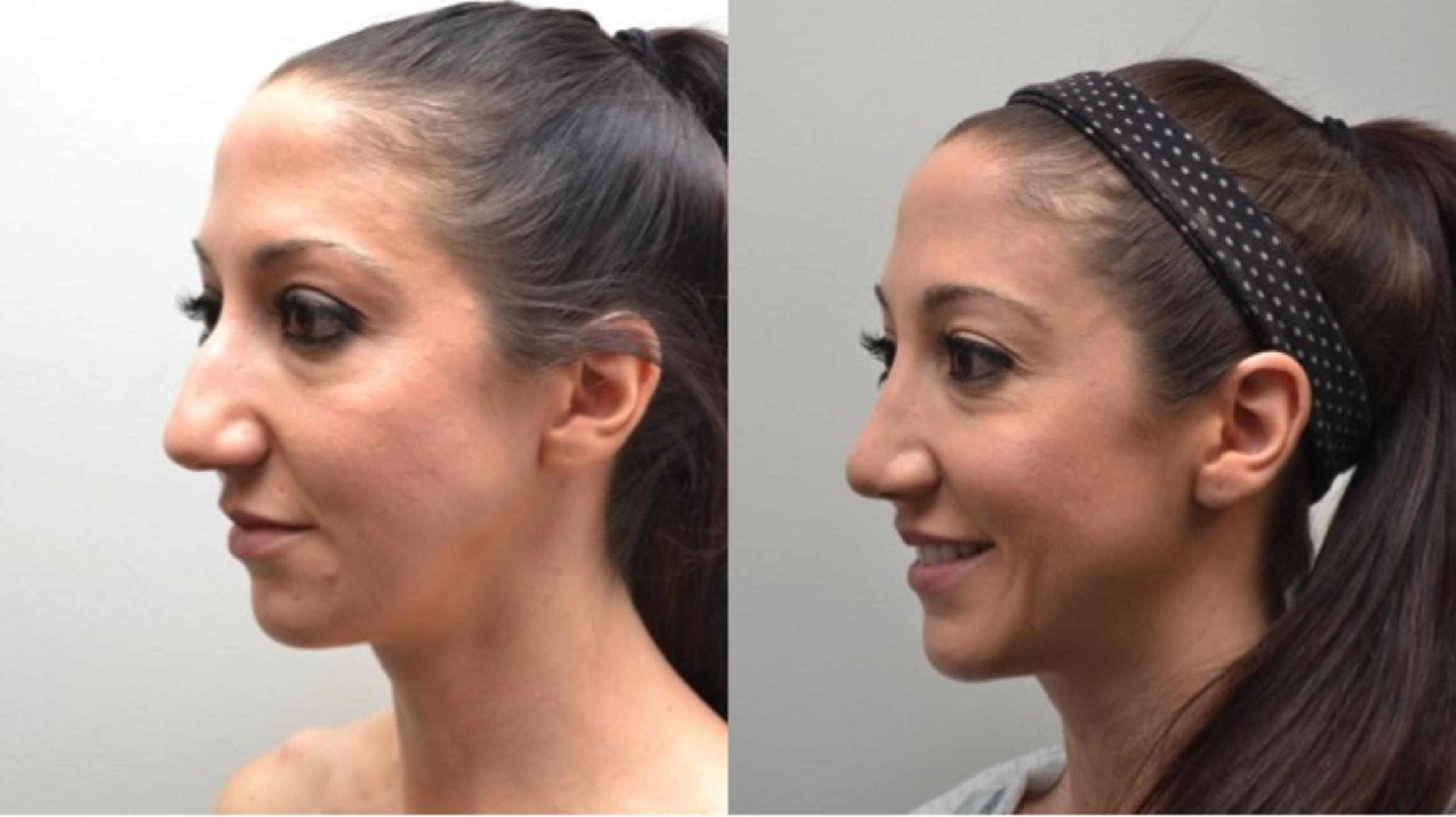Before & After Rhinoplasty Case 258 View #3 View in Albany & Latham, New York