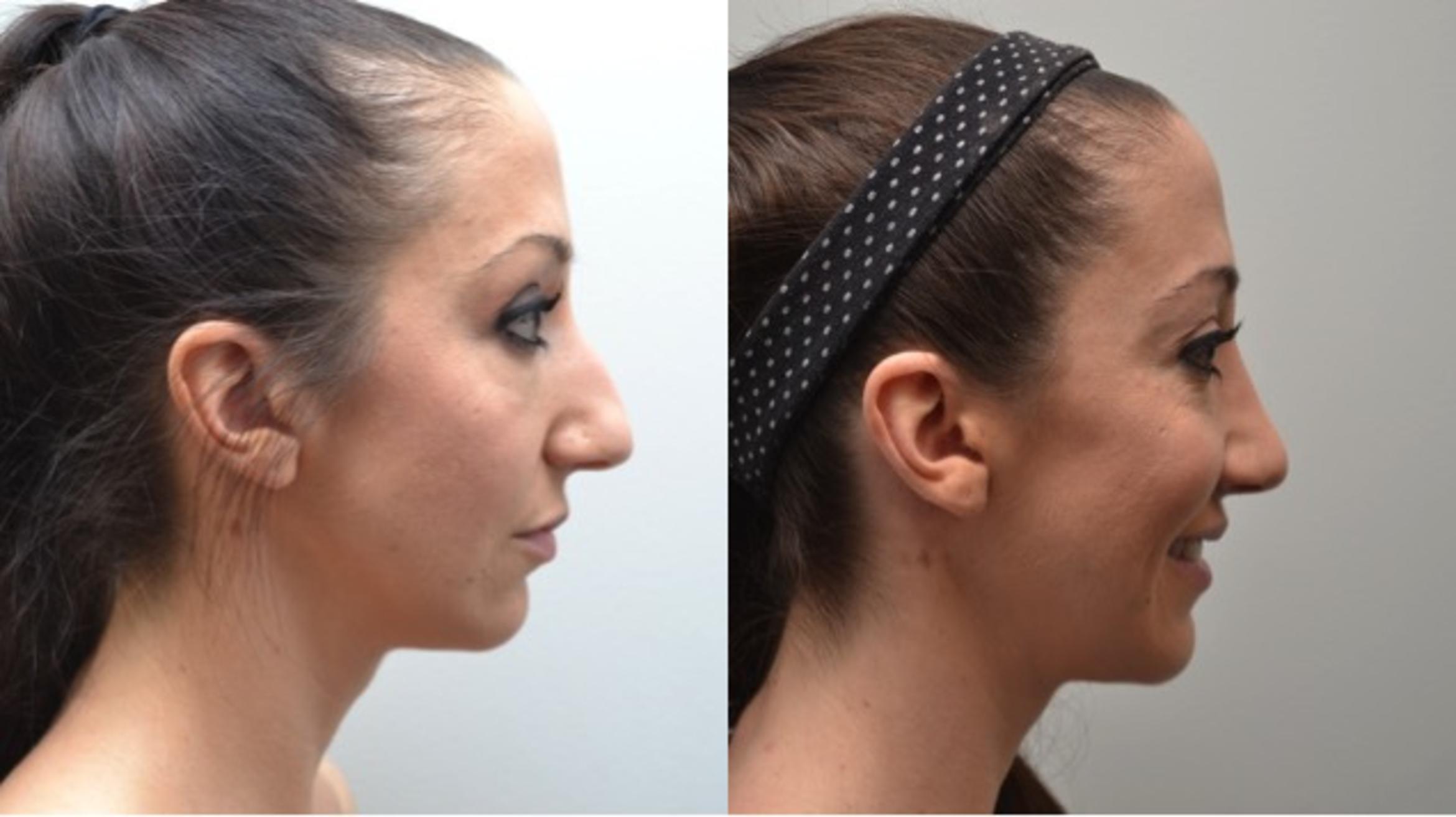 Rhinoplasty Before & After Photos Patient 258 Albany & Latham, New York Rockmore Plastic Surgery