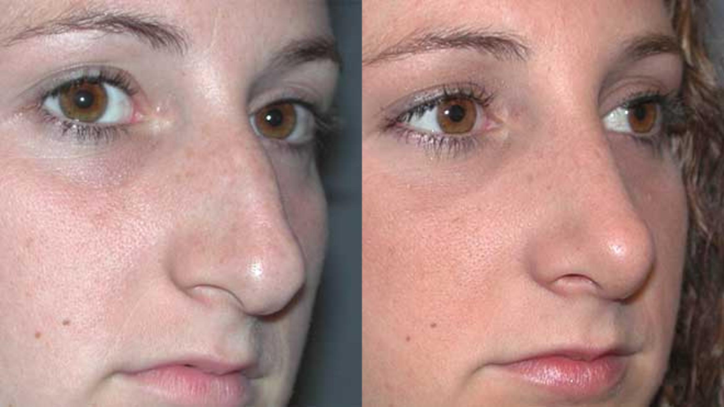 Before & After Rhinoplasty Case 26 View #3 View in Albany & Latham, New York
