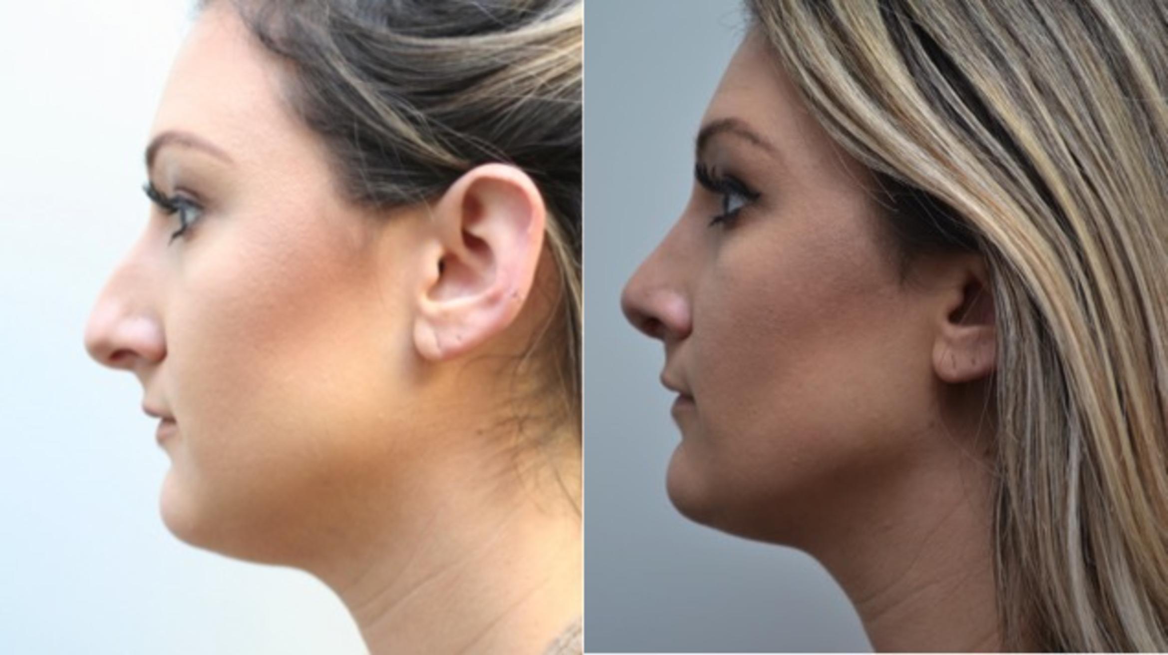 Rhinoplasty Before & After Photos Patient 260 Latham, New York Rockmore Plastic Surgery