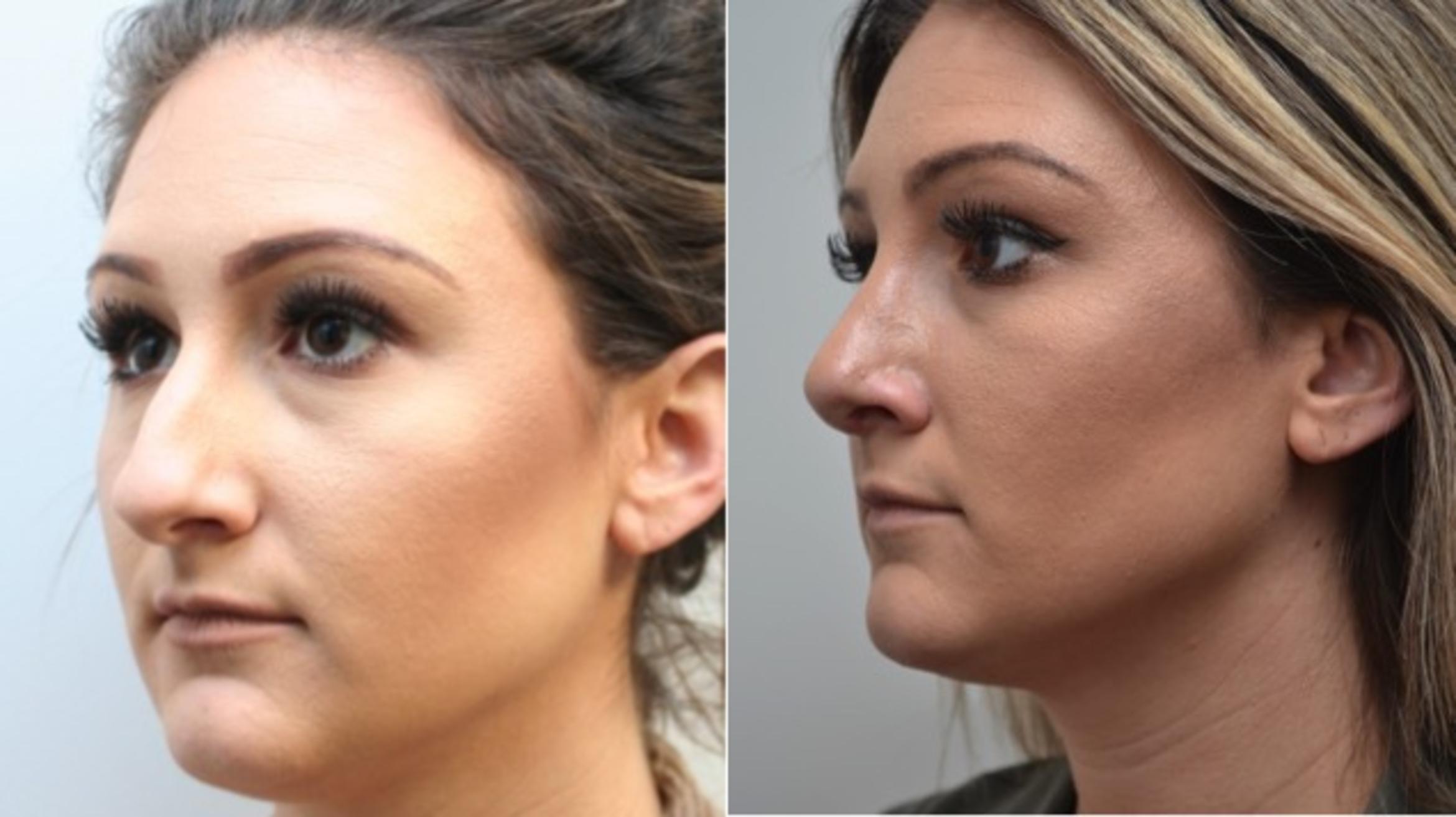 Before & After Rhinoplasty Case 260 View #3 View in Albany & Latham, New York