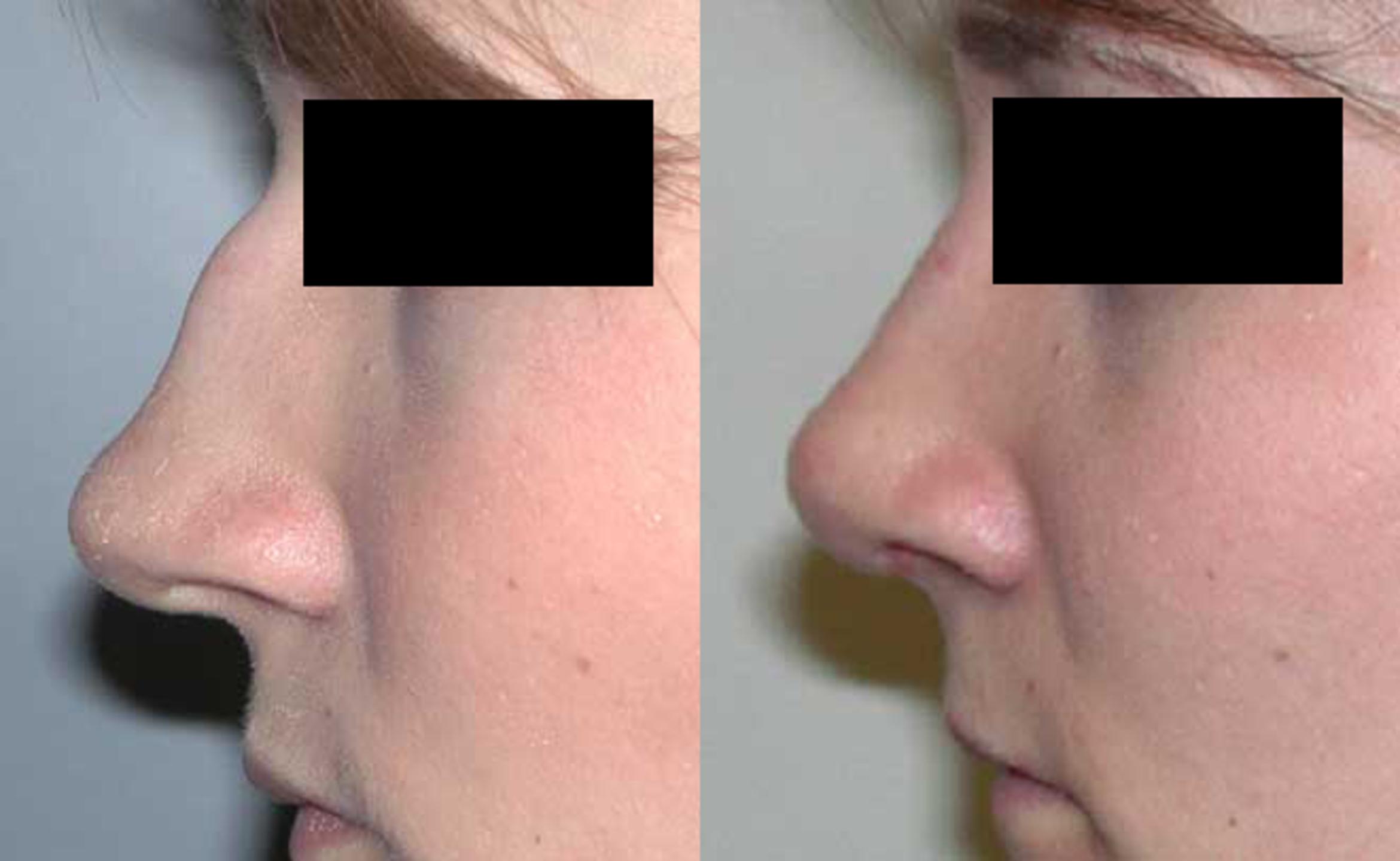 Before & After Rhinoplasty Case 27 View #1 View in Albany & Latham, New York