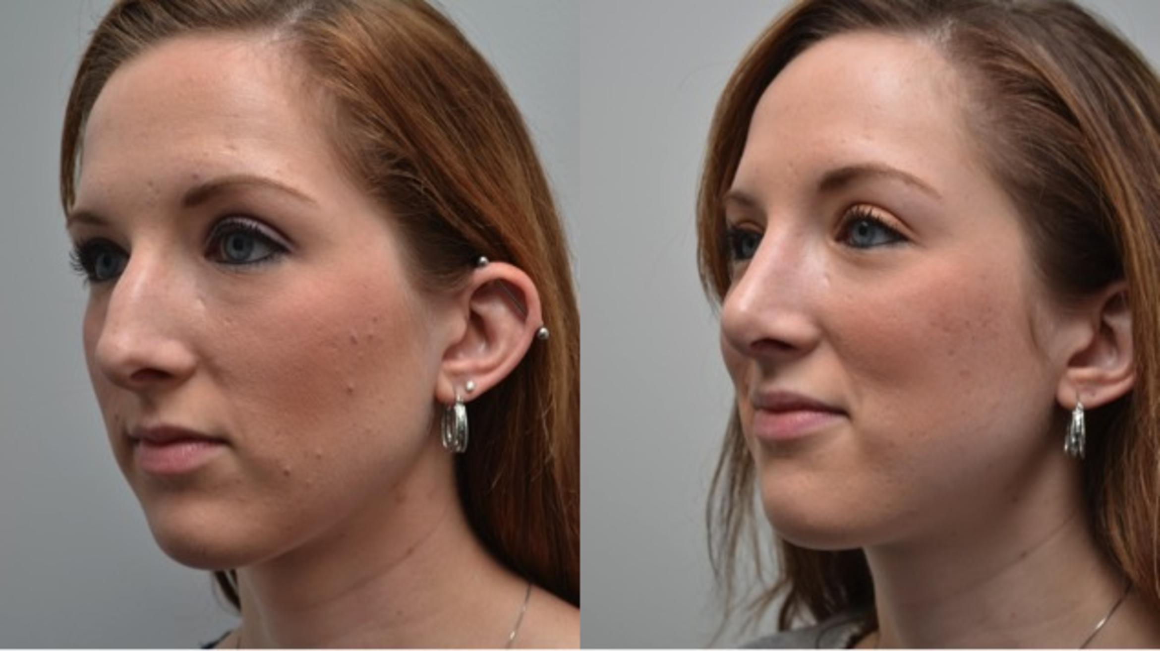 Before & After Rhinoplasty Case 272 View #3 View in Albany & Latham, New York