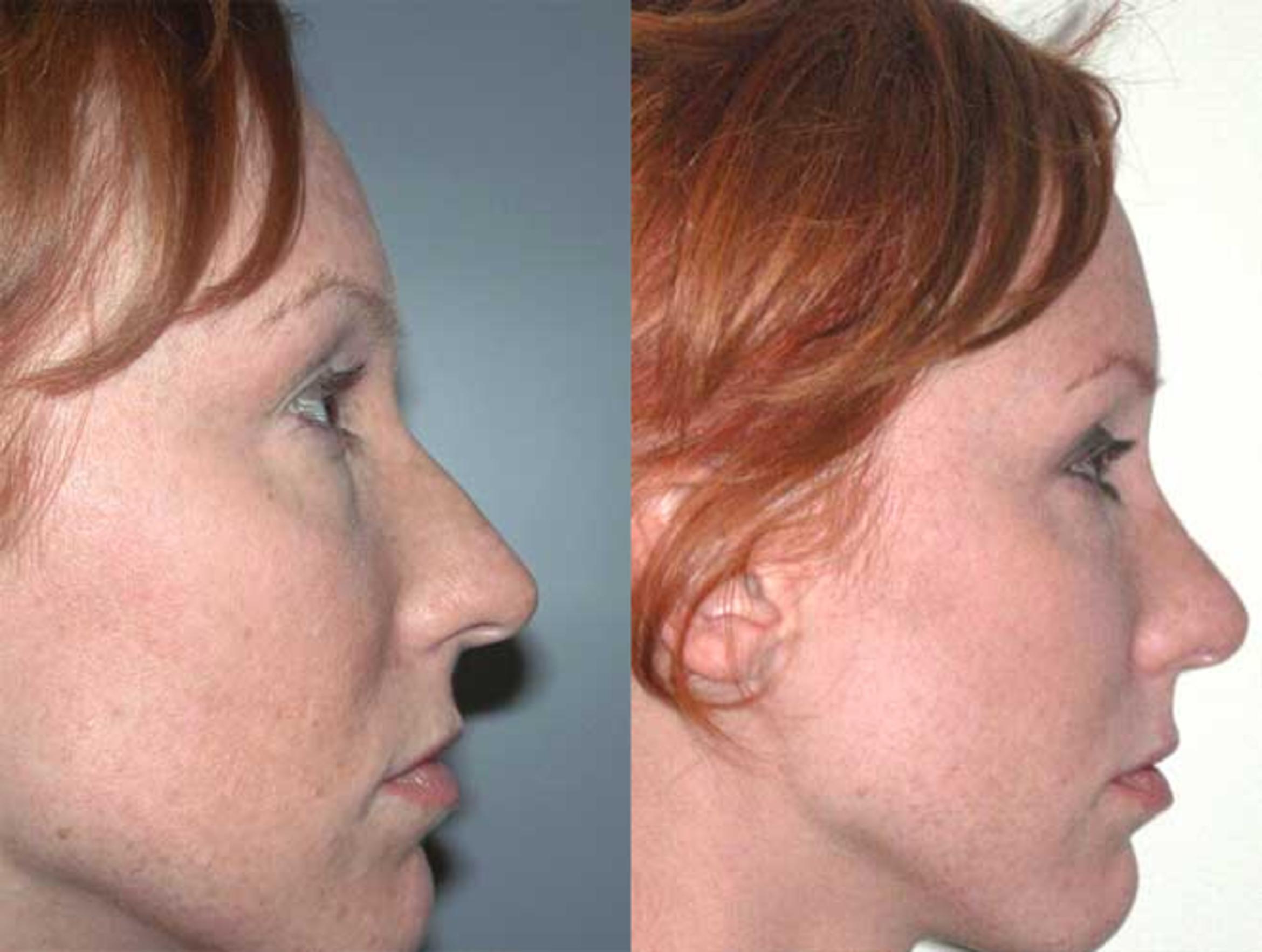 Before & After Rhinoplasty Case 28 View #3 View in Albany & Latham, New York