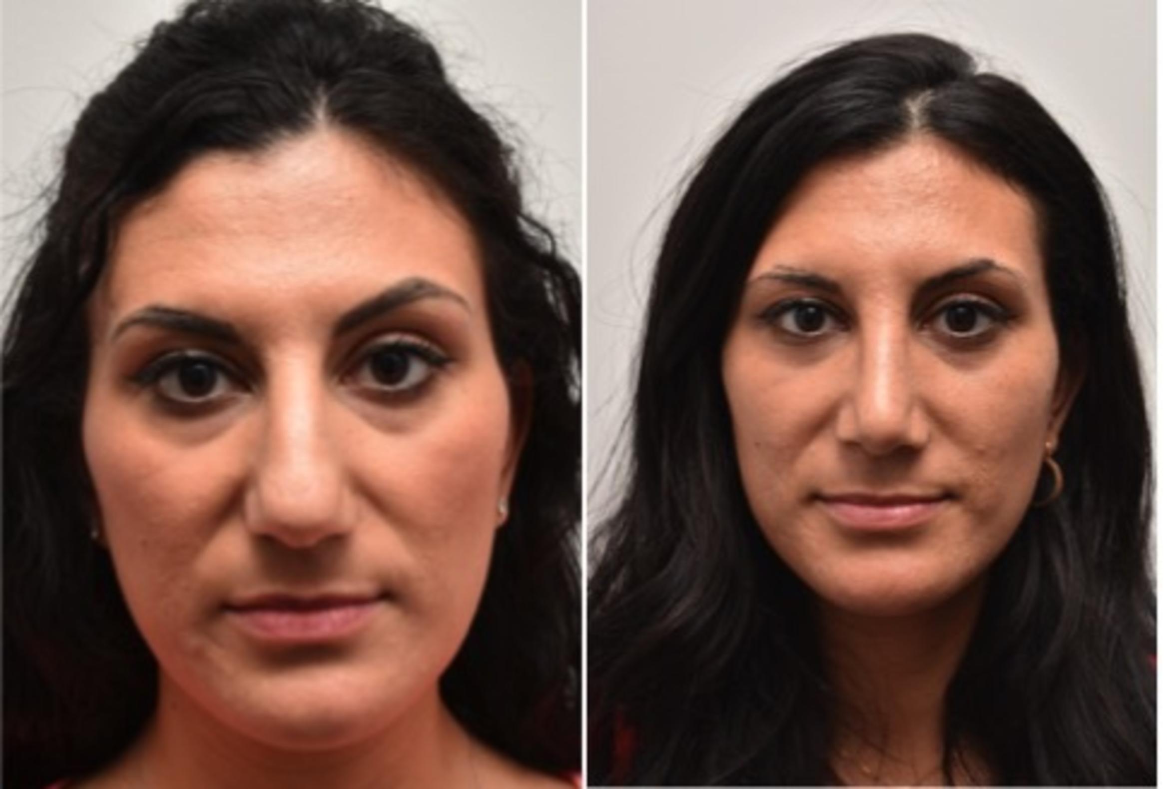 Before & After Rhinoplasty Case 294 View #1 View in Albany & Latham, New York