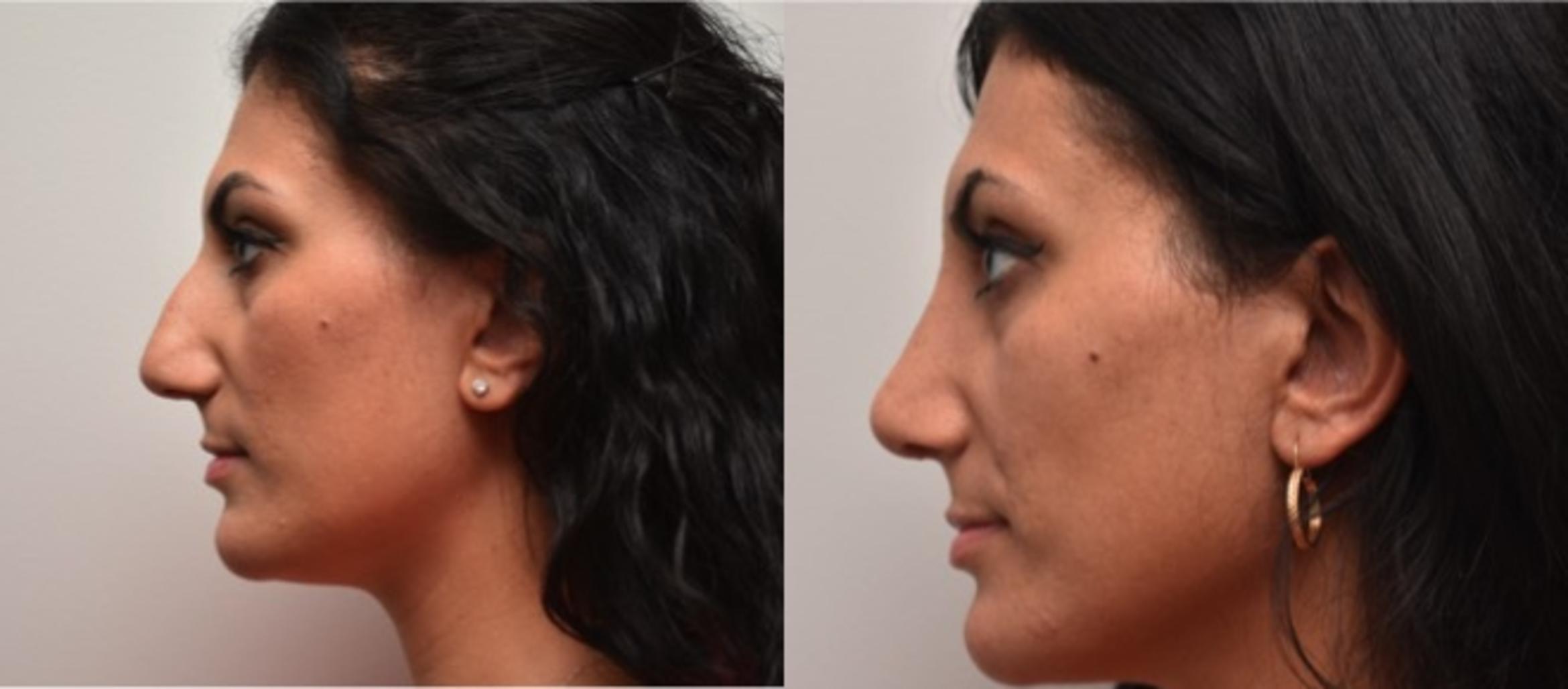 Before & After Rhinoplasty Case 294 View #2 View in Albany & Latham, New York