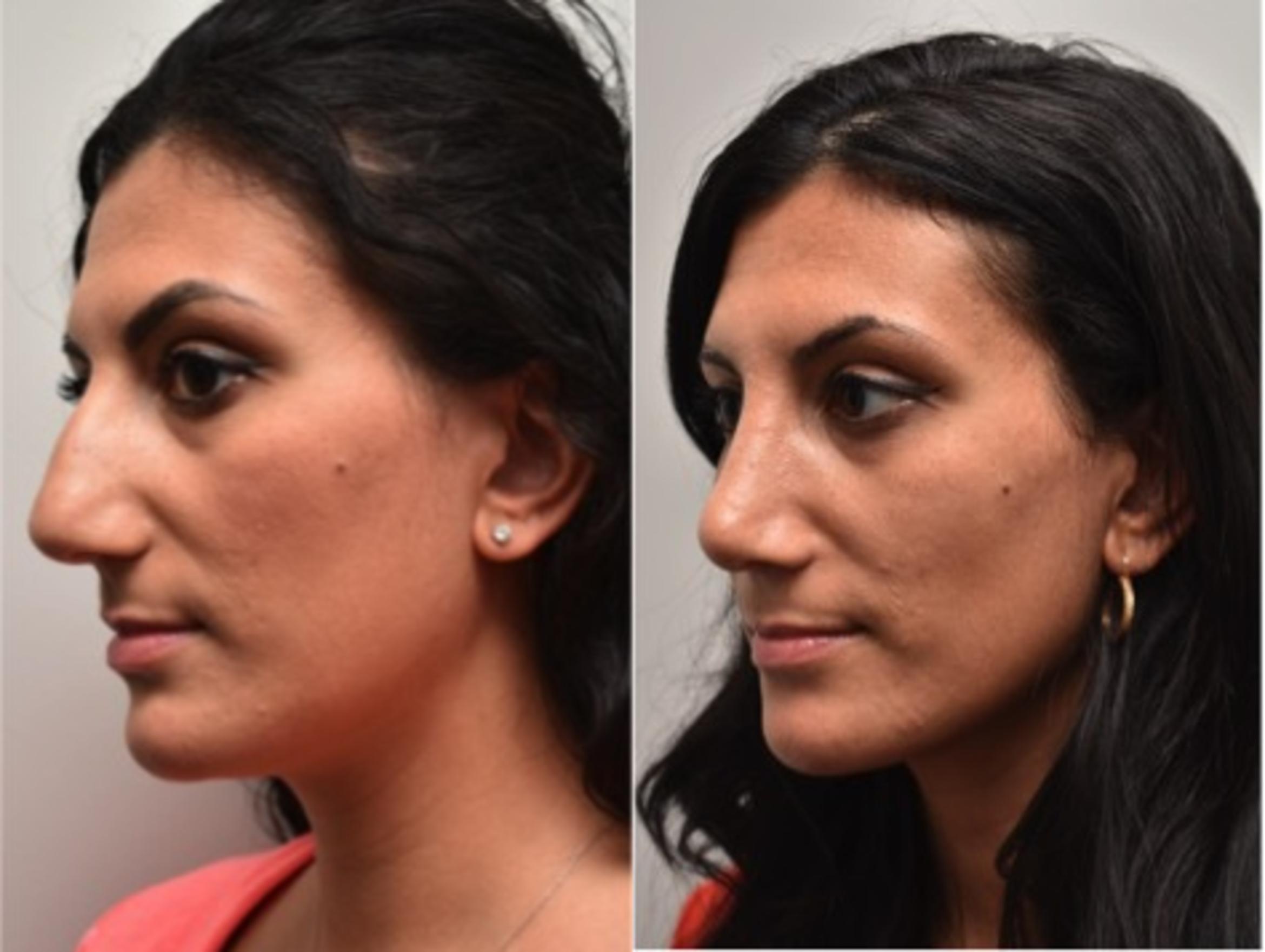 Before & After Rhinoplasty Case 294 View #3 View in Albany & Latham, New York