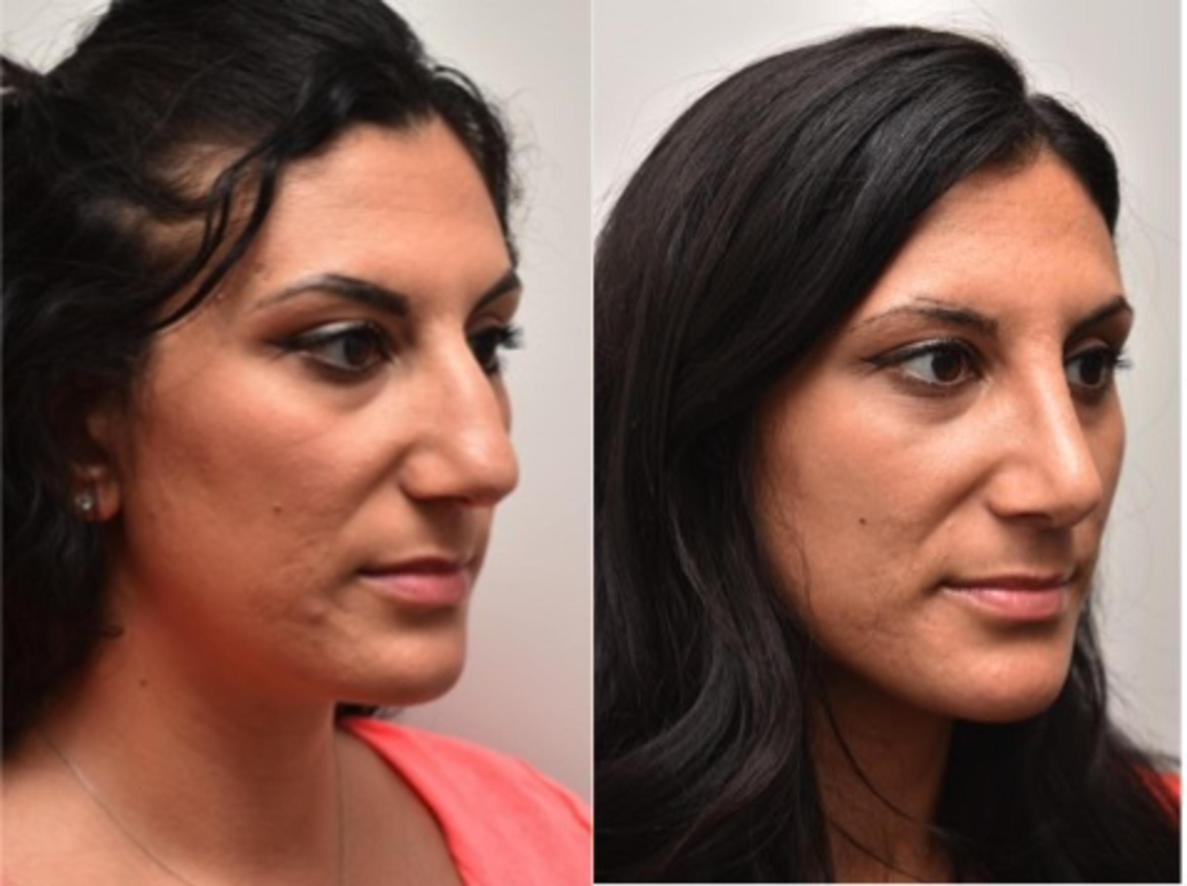 Before & After Rhinoplasty Case 294 View #4 View in Albany & Latham, New York